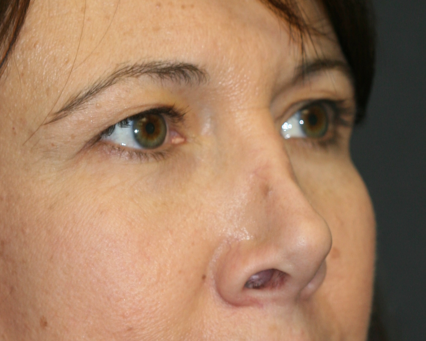 Non-Surgical Rhinoplasty utilizing Restylane Filler