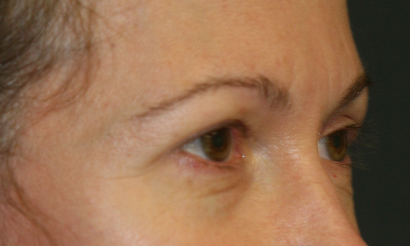 Eyelid Surgery - Before & After - Dr. Placik