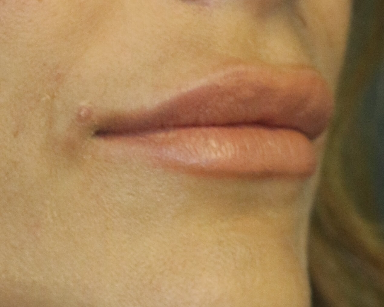 Lip Enhancement - Before & After - Dr. Placik