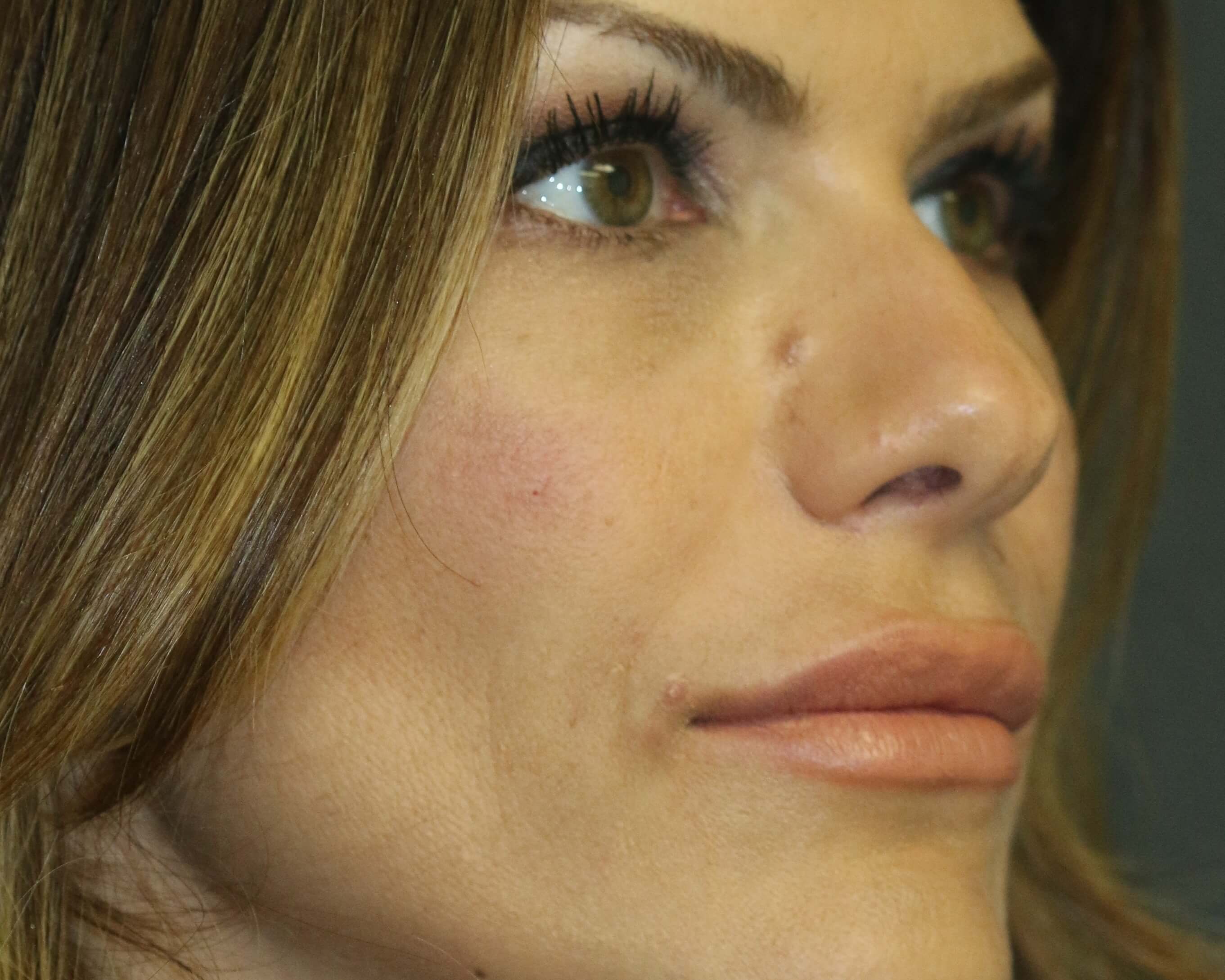 Injectable Filler Chicago