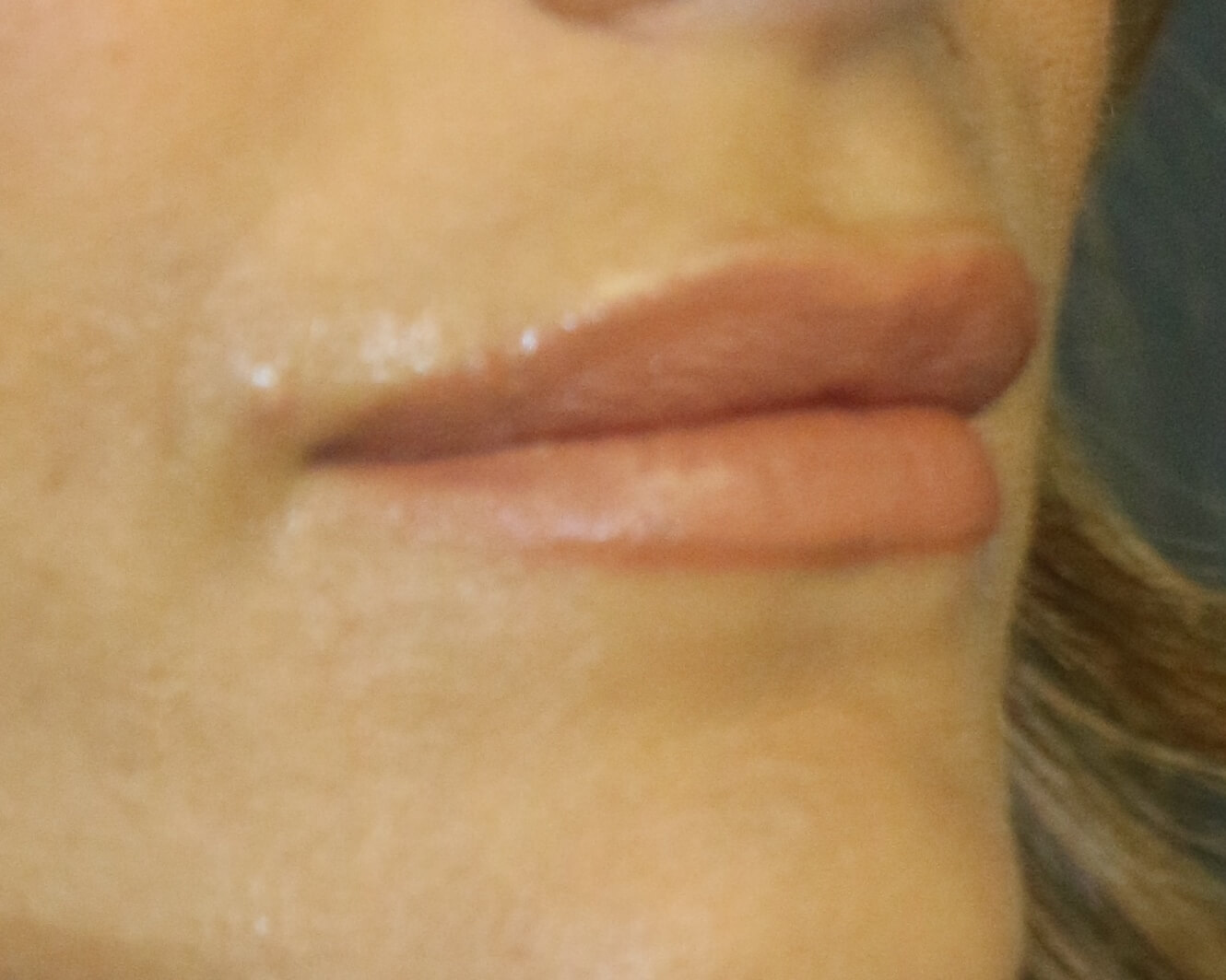 Lip Enhancement - Before & After - Dr. Placik