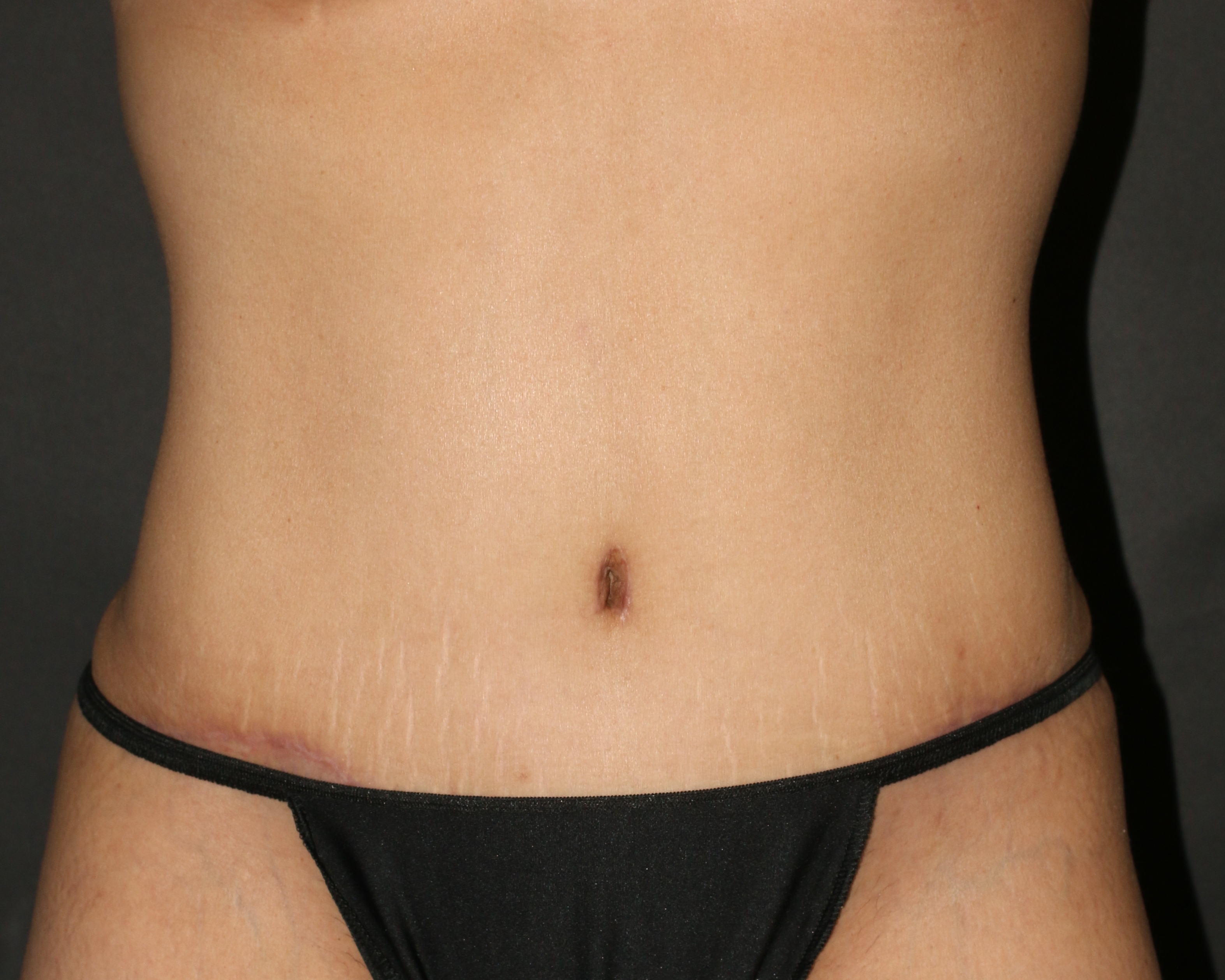 Tummy Tuck - Before & After - Dr. Placik