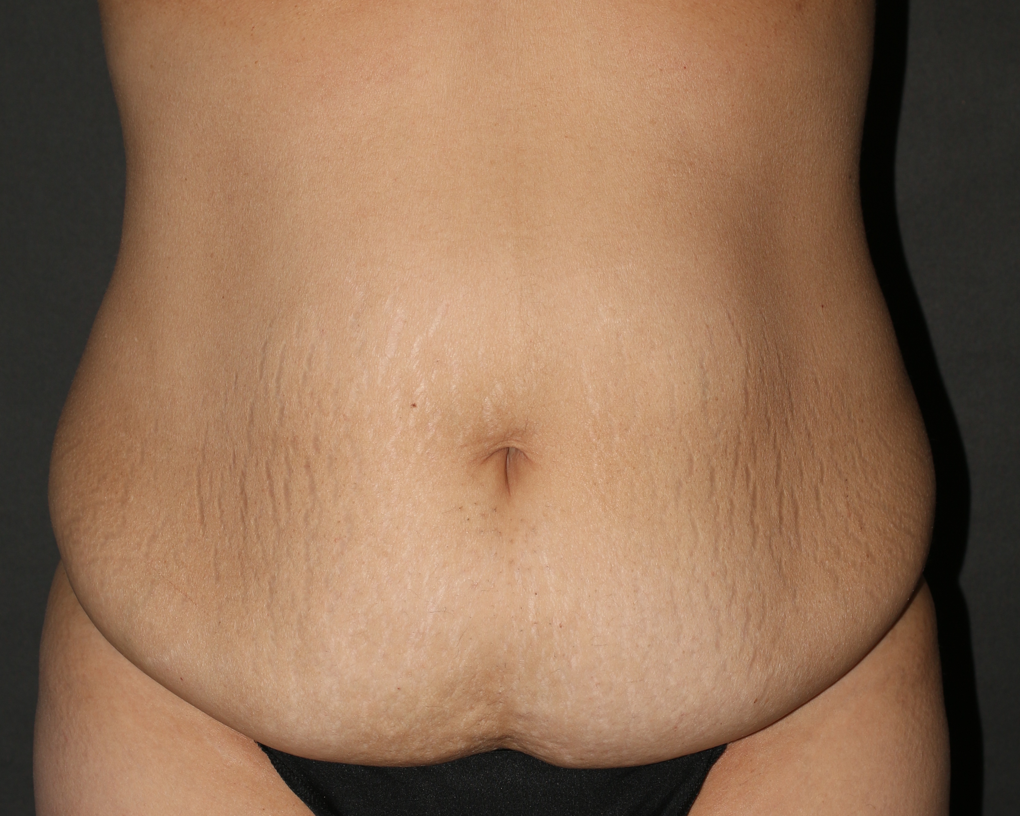 Tummy Tuck - Before & After - Dr. Placik