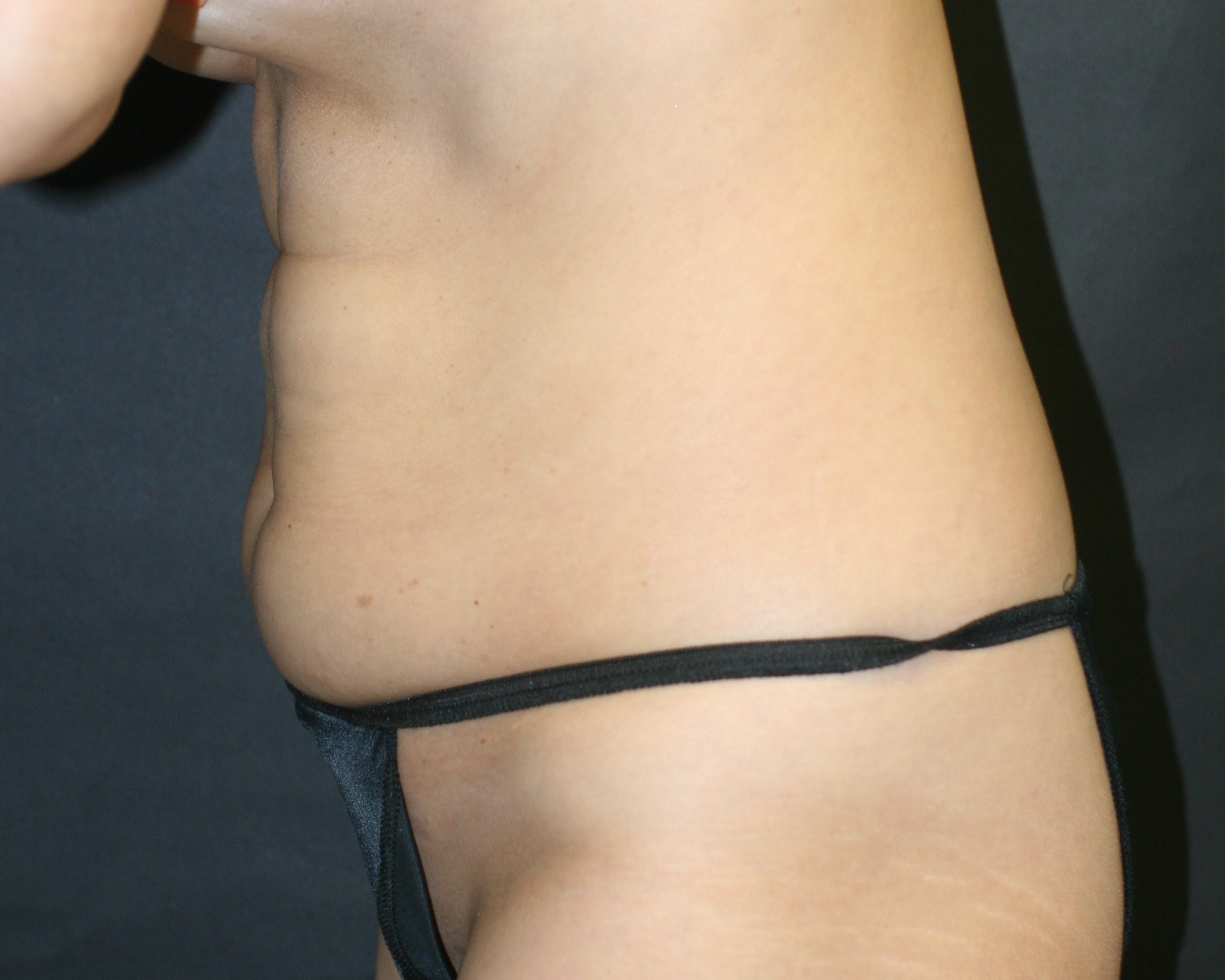 Tummy Tuck - Before & After - Dr. Placik