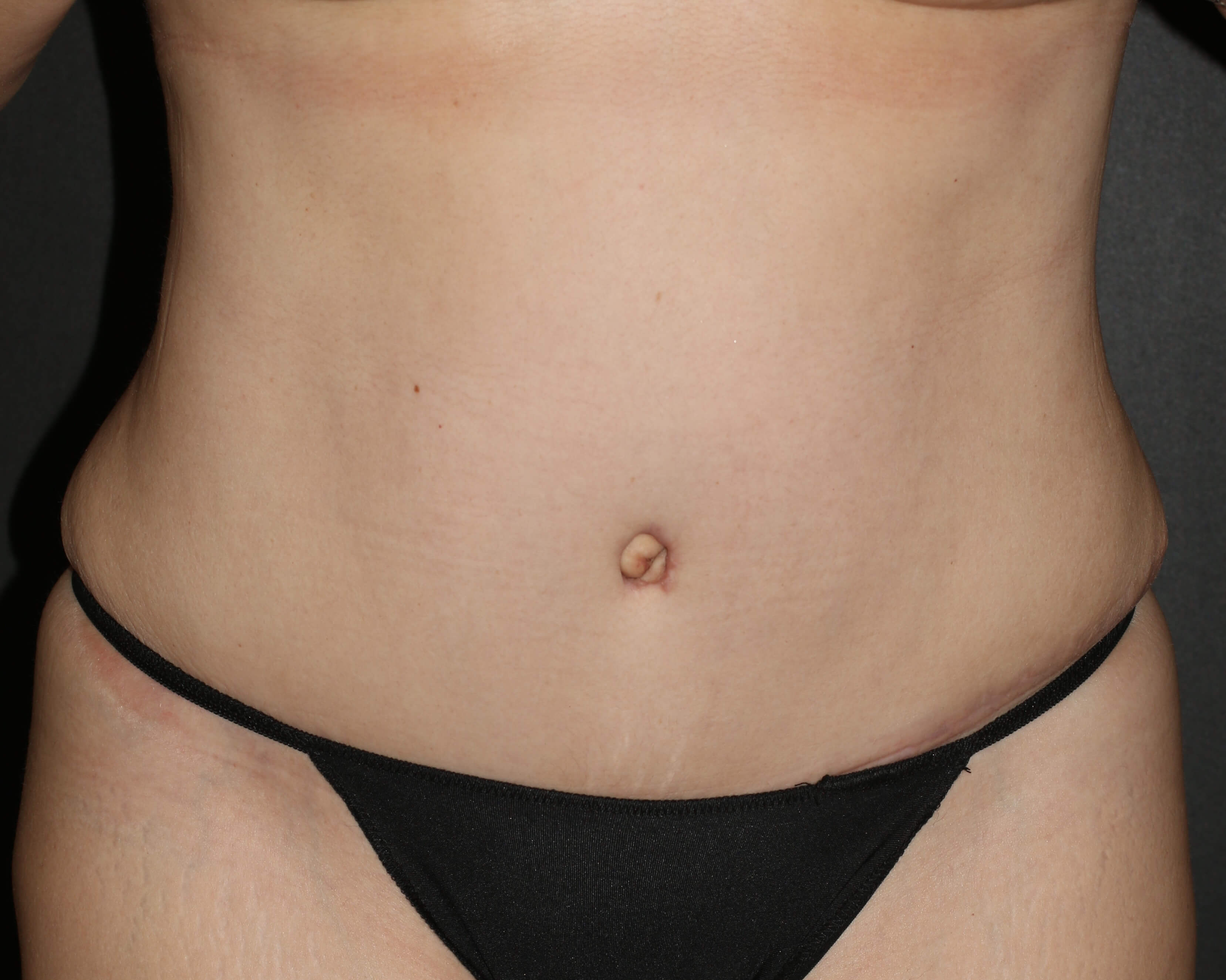 Tummy Tuck - Before & After - Dr. Placik