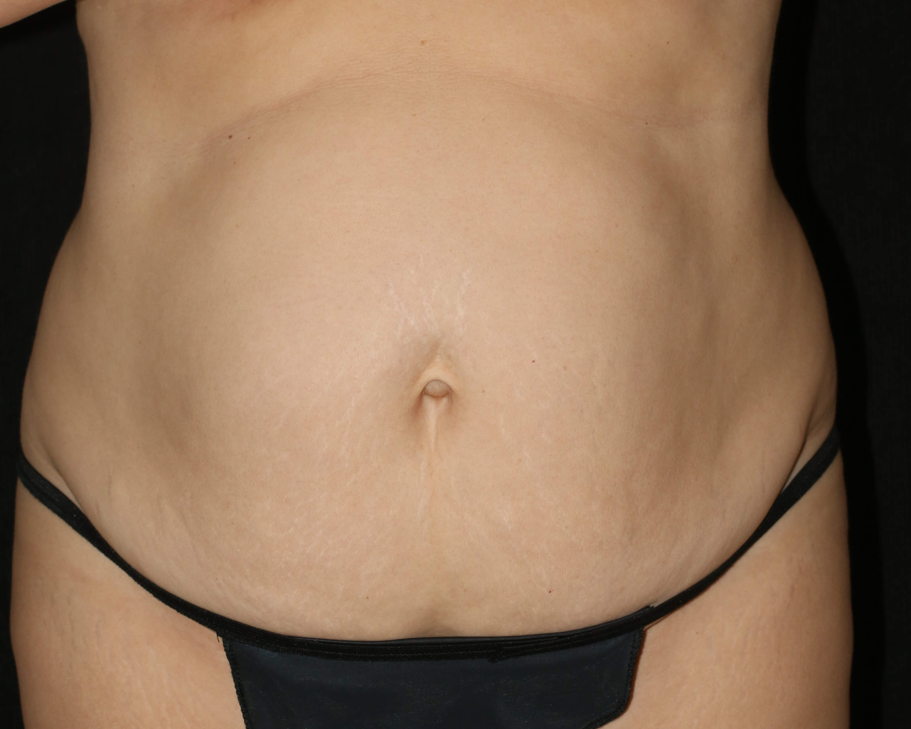 Tummy Tuck - Before & After - Dr. Placik