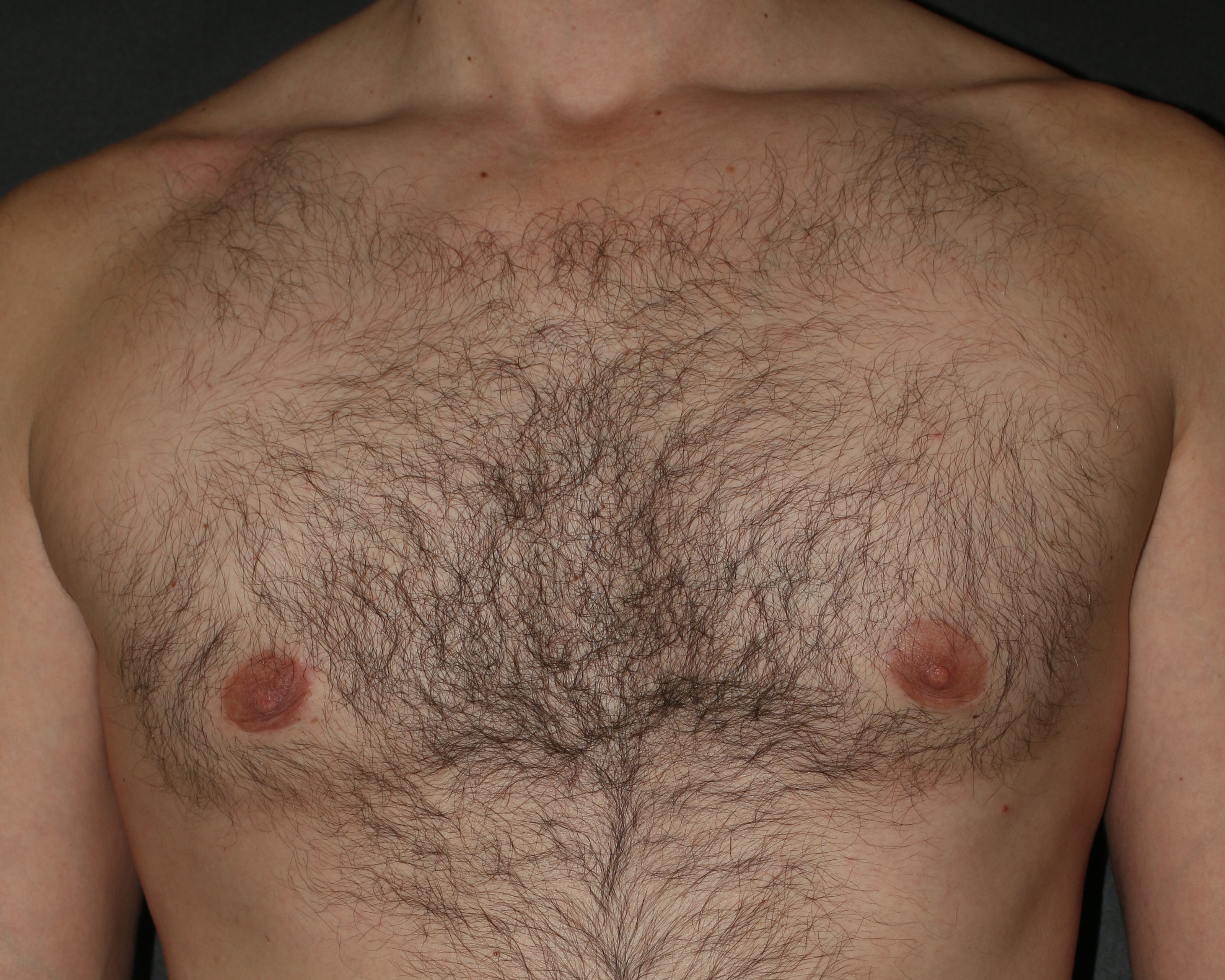 Male Breast Reduction - Before & After - Dr. Placik