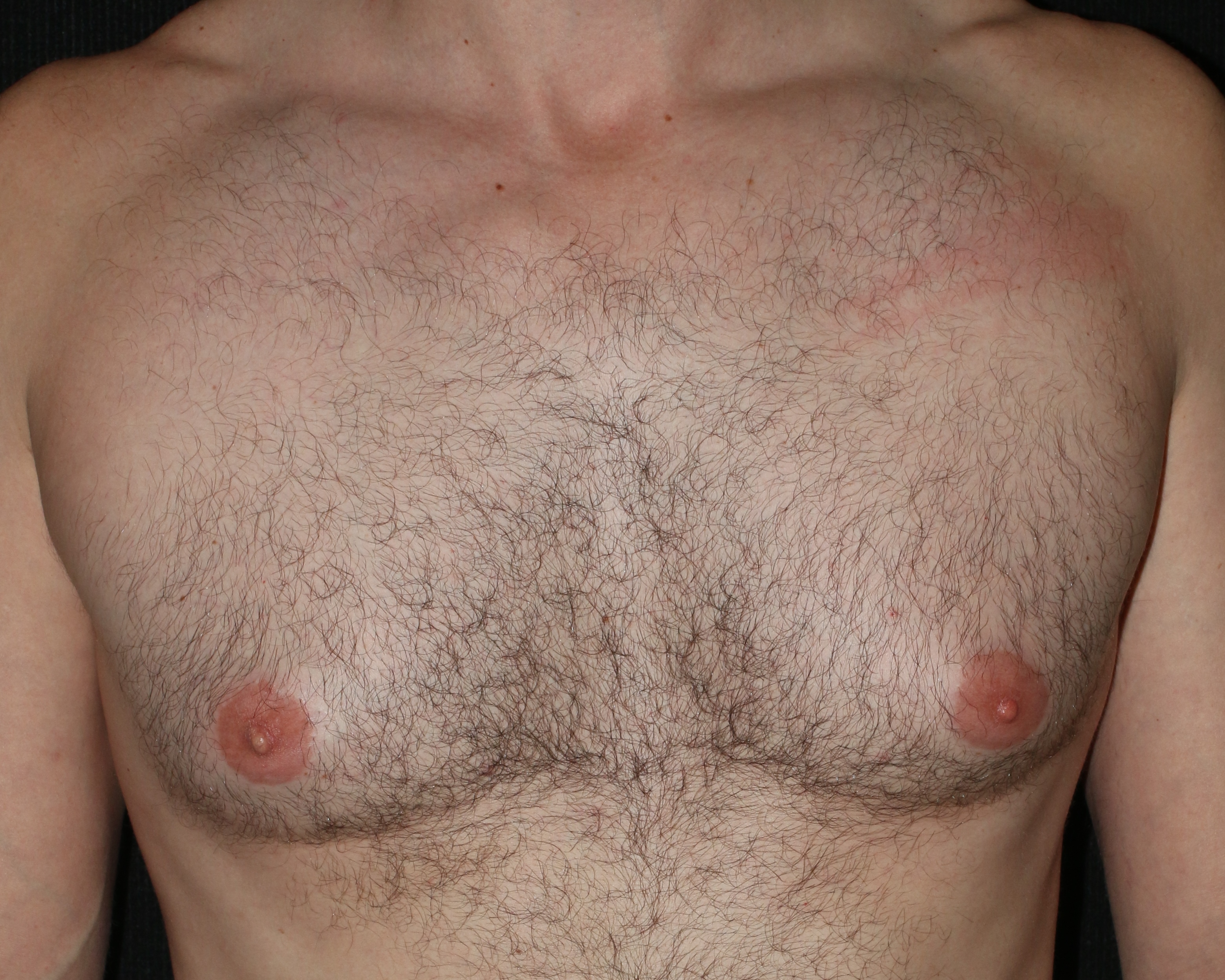 Male Breast Reduction - Before & After - Dr. Placik