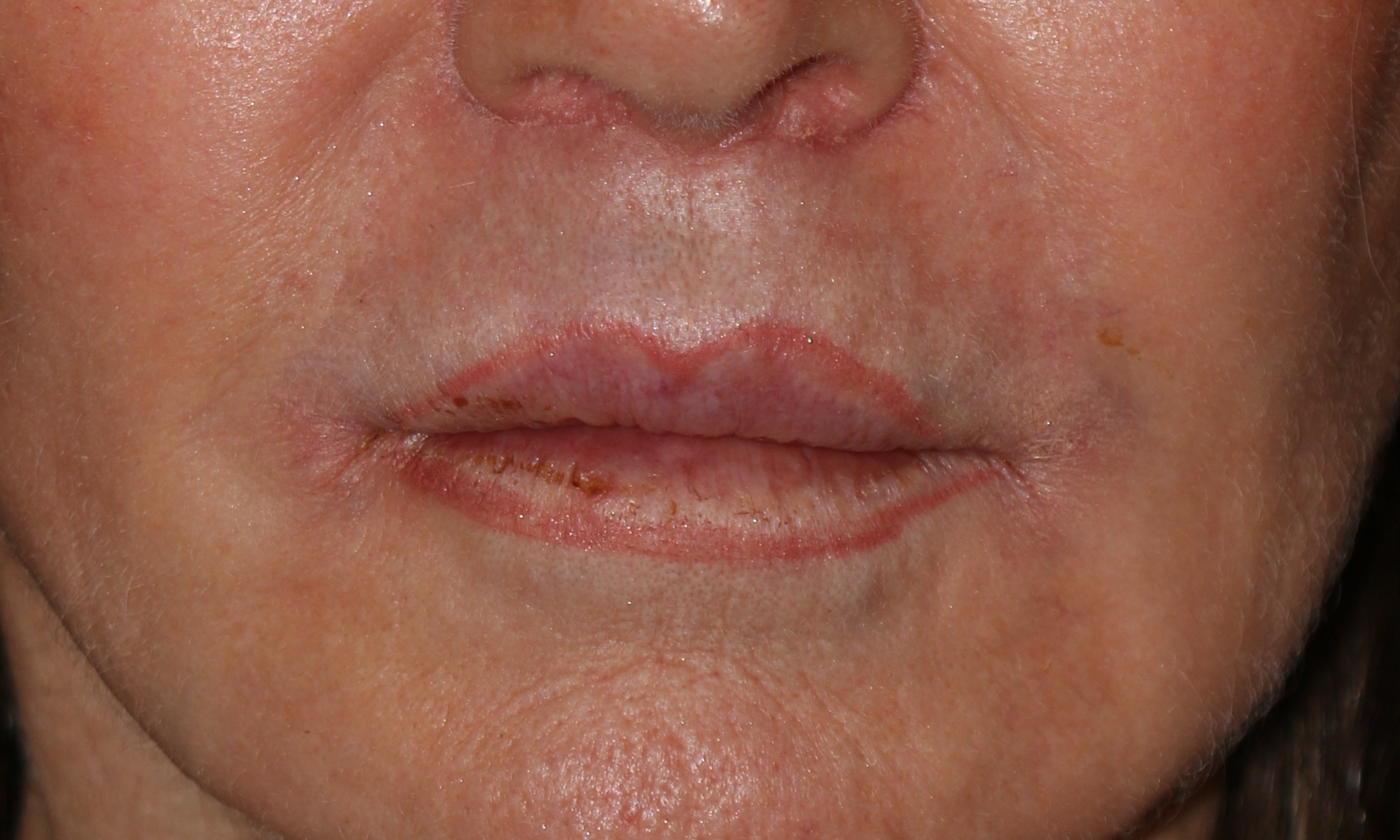 Lip Lift - Before & After - Dr. Placik