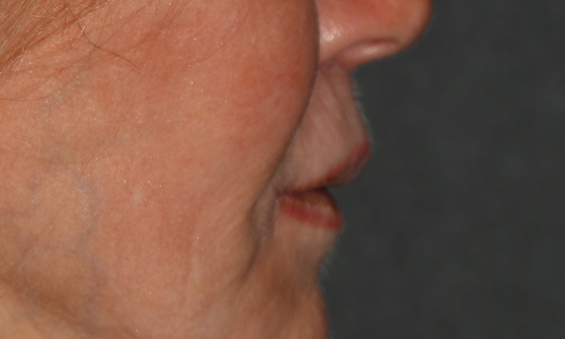 This patient had a bullhorn lip lift