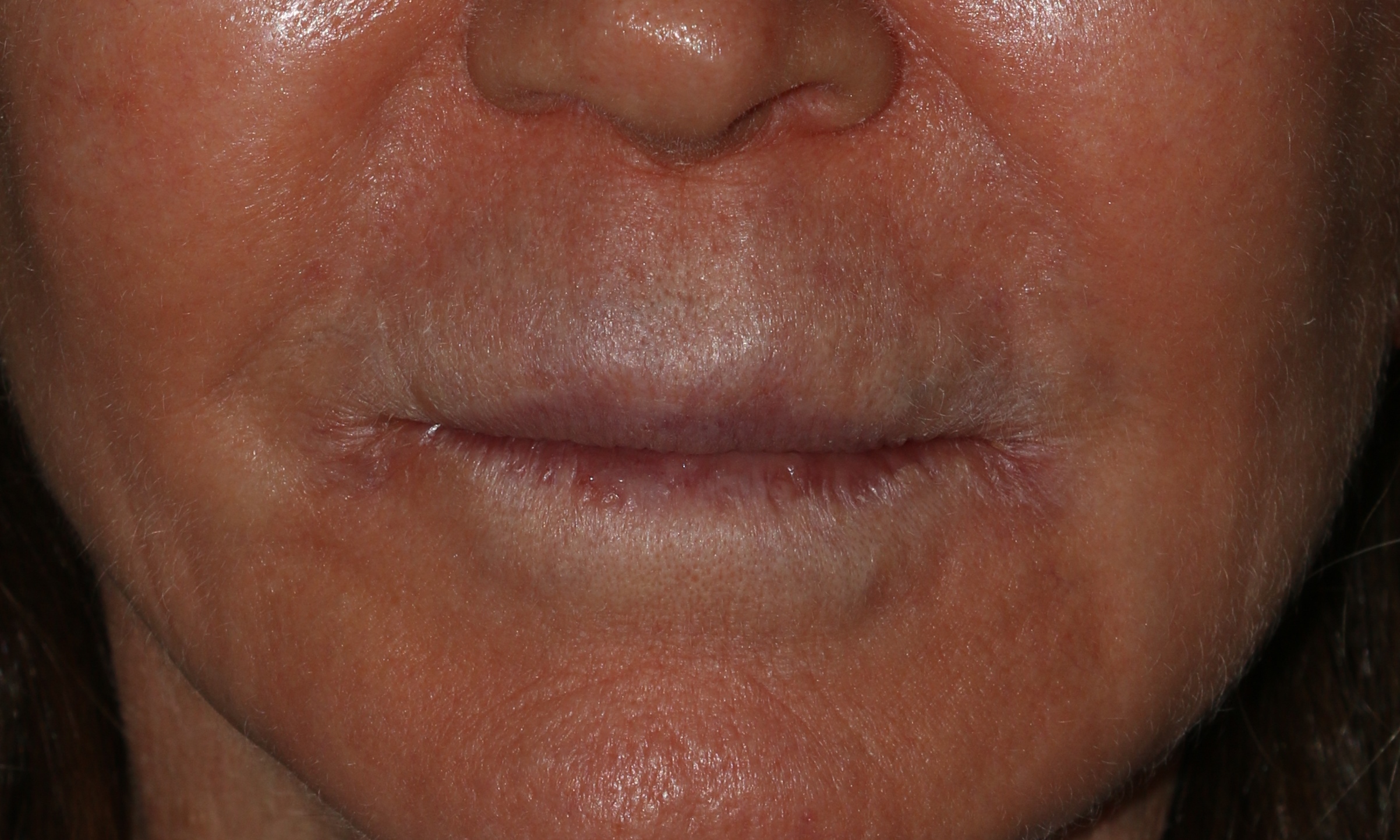 Lip Lift - Before & After - Dr. Placik