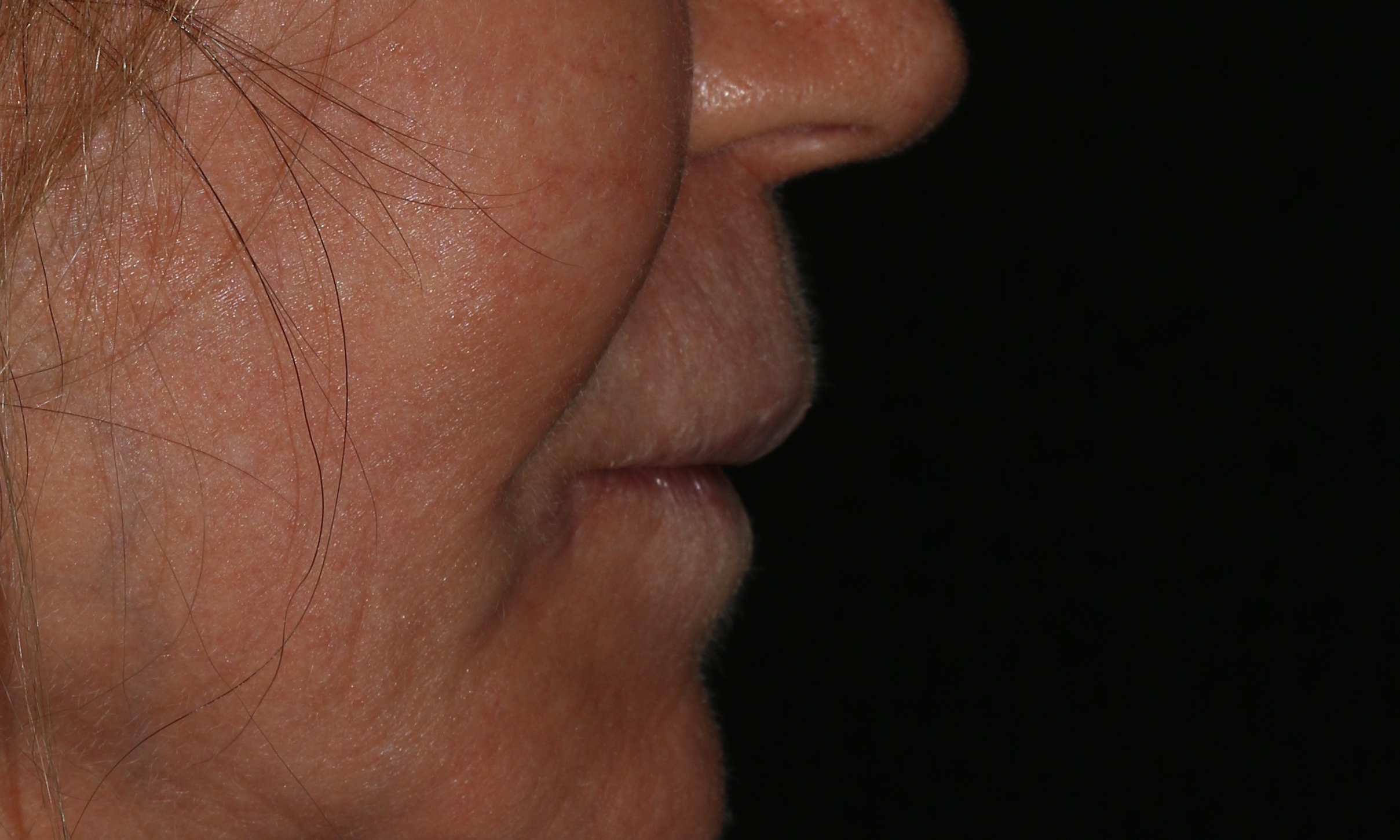 This patient had a bullhorn lip lift