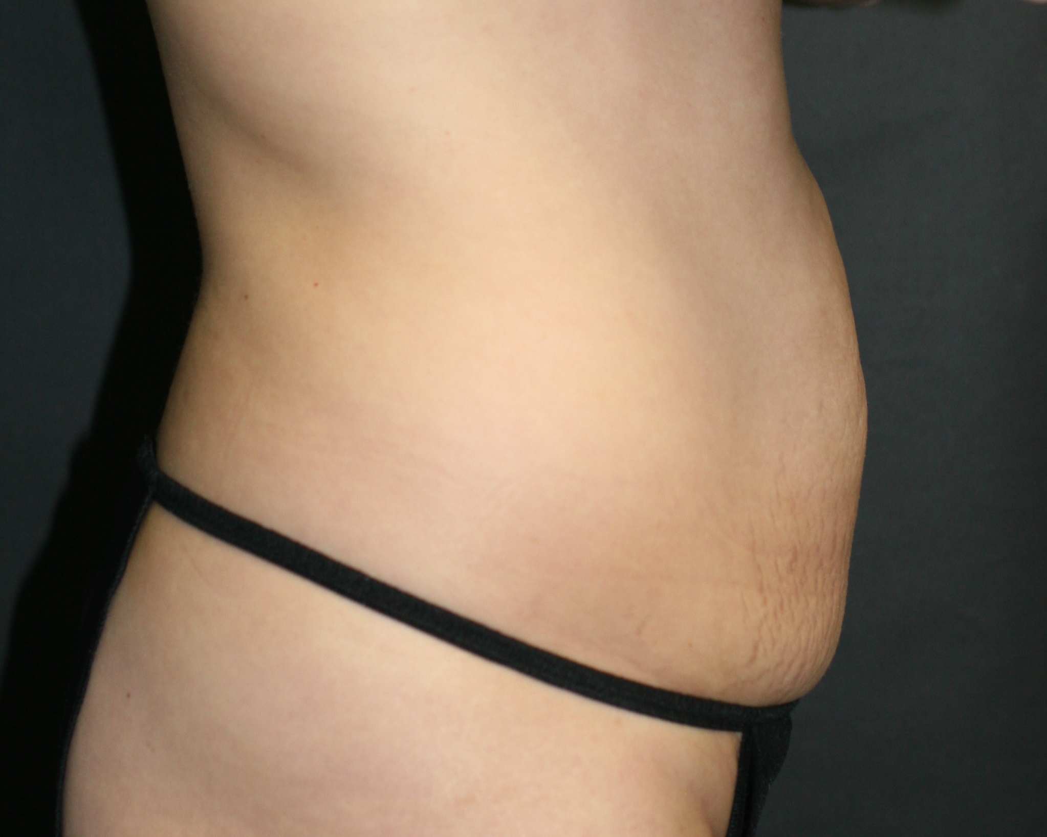 Tummy Tuck - Before & After - Dr. Placik