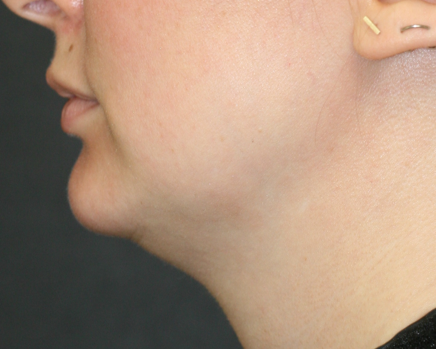 Kybella - Before & After - Dr. Placik