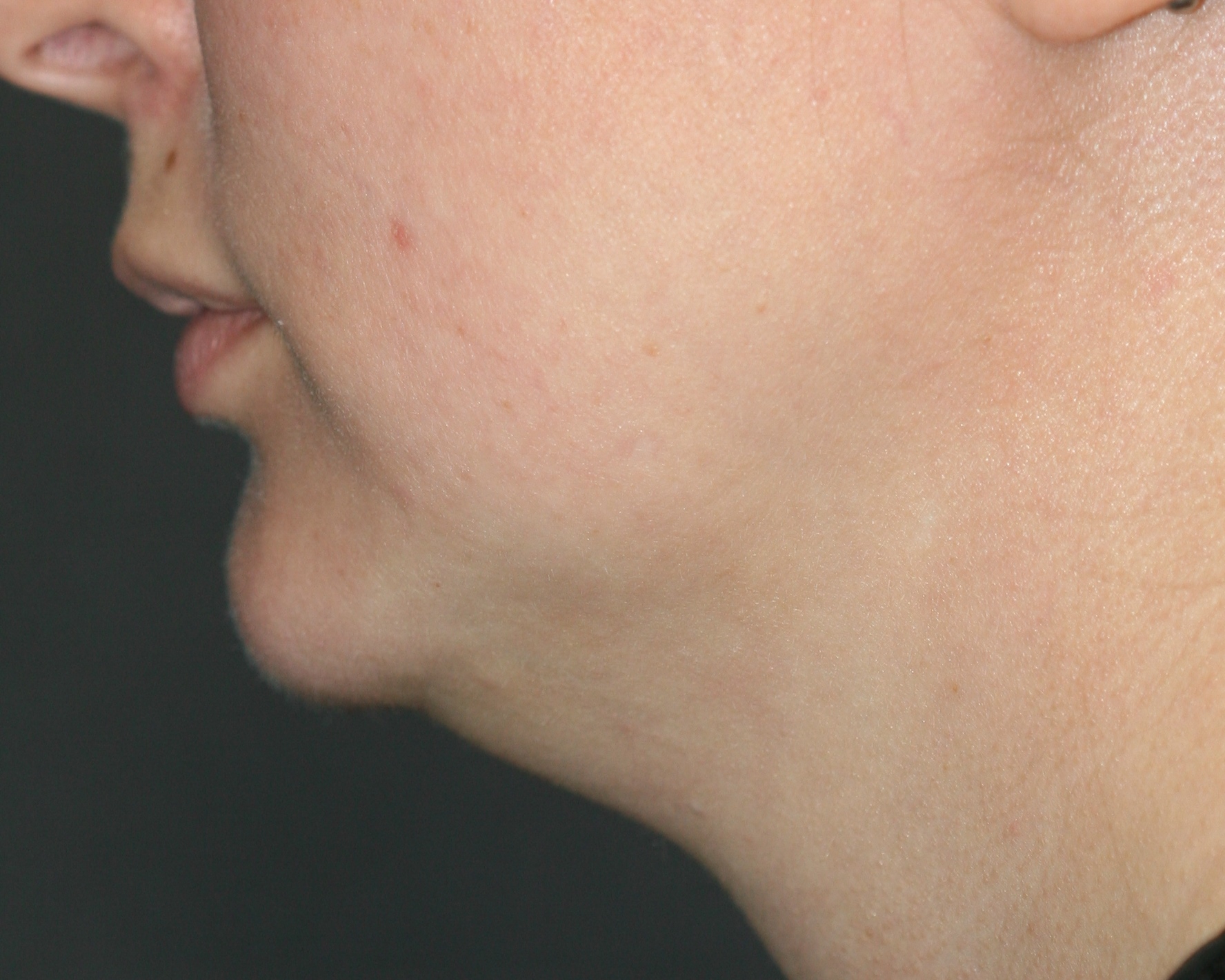 Kybella - Before & After - Dr. Placik