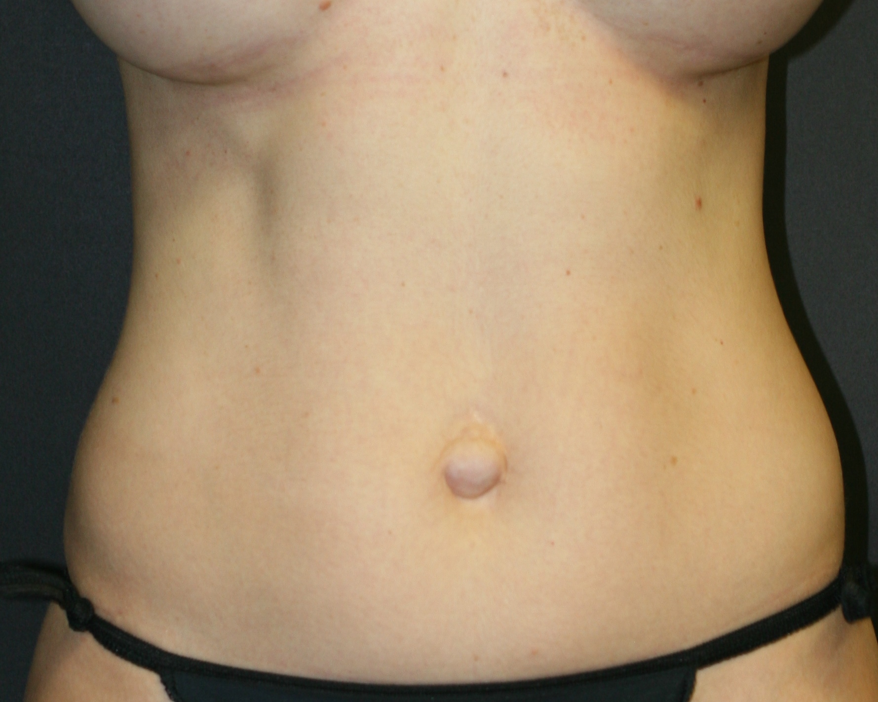 Liposuction Chicago