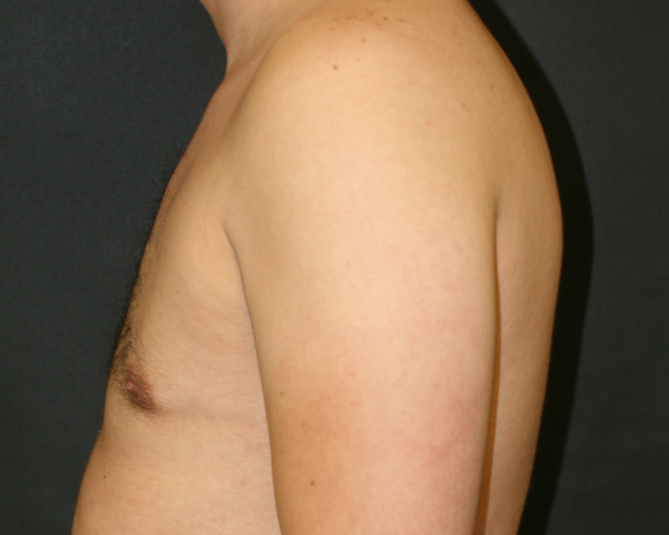 Gynecomastia with Liposuction to the Breasts