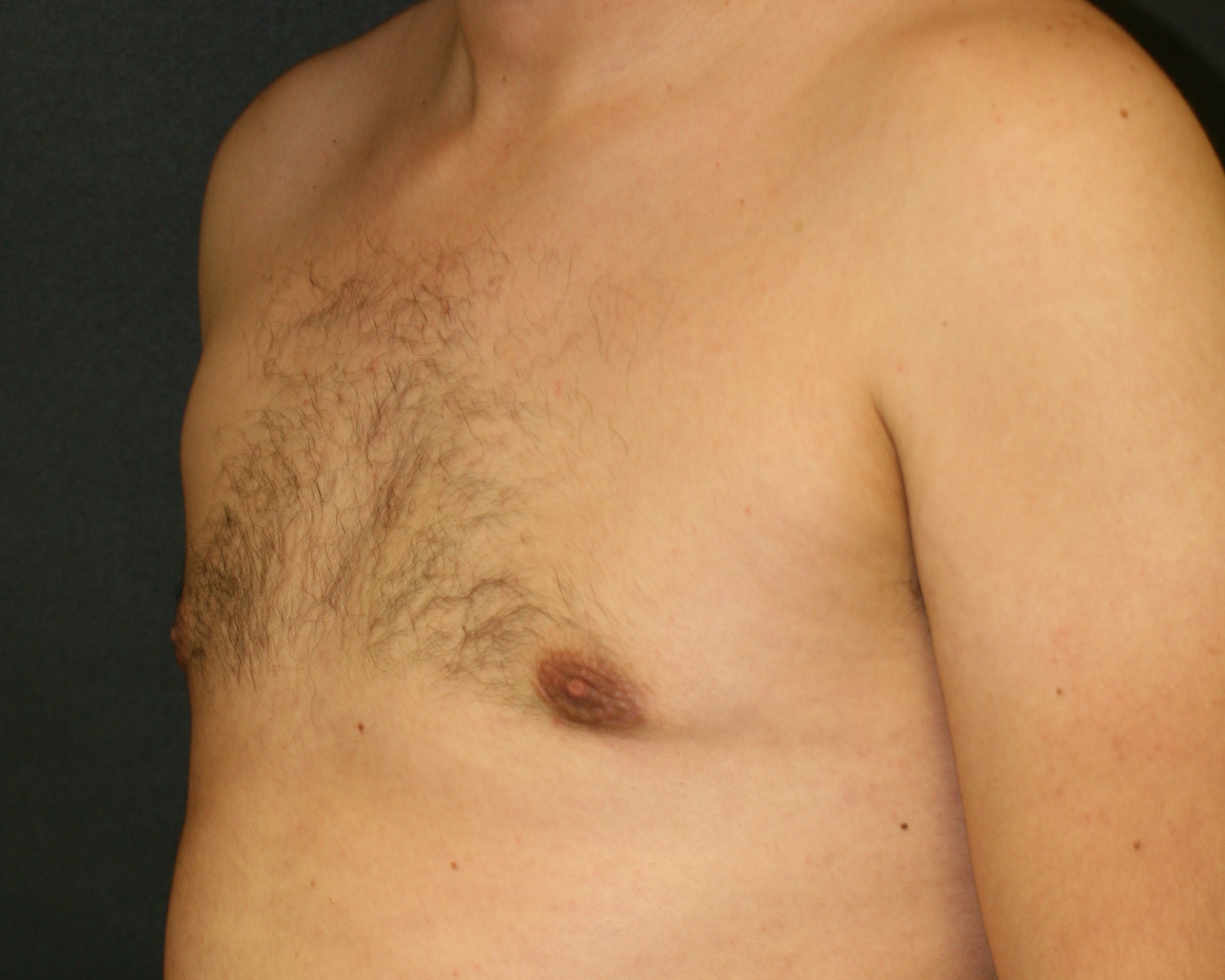 Male Breast Reduction - Before & After - Dr. Placik