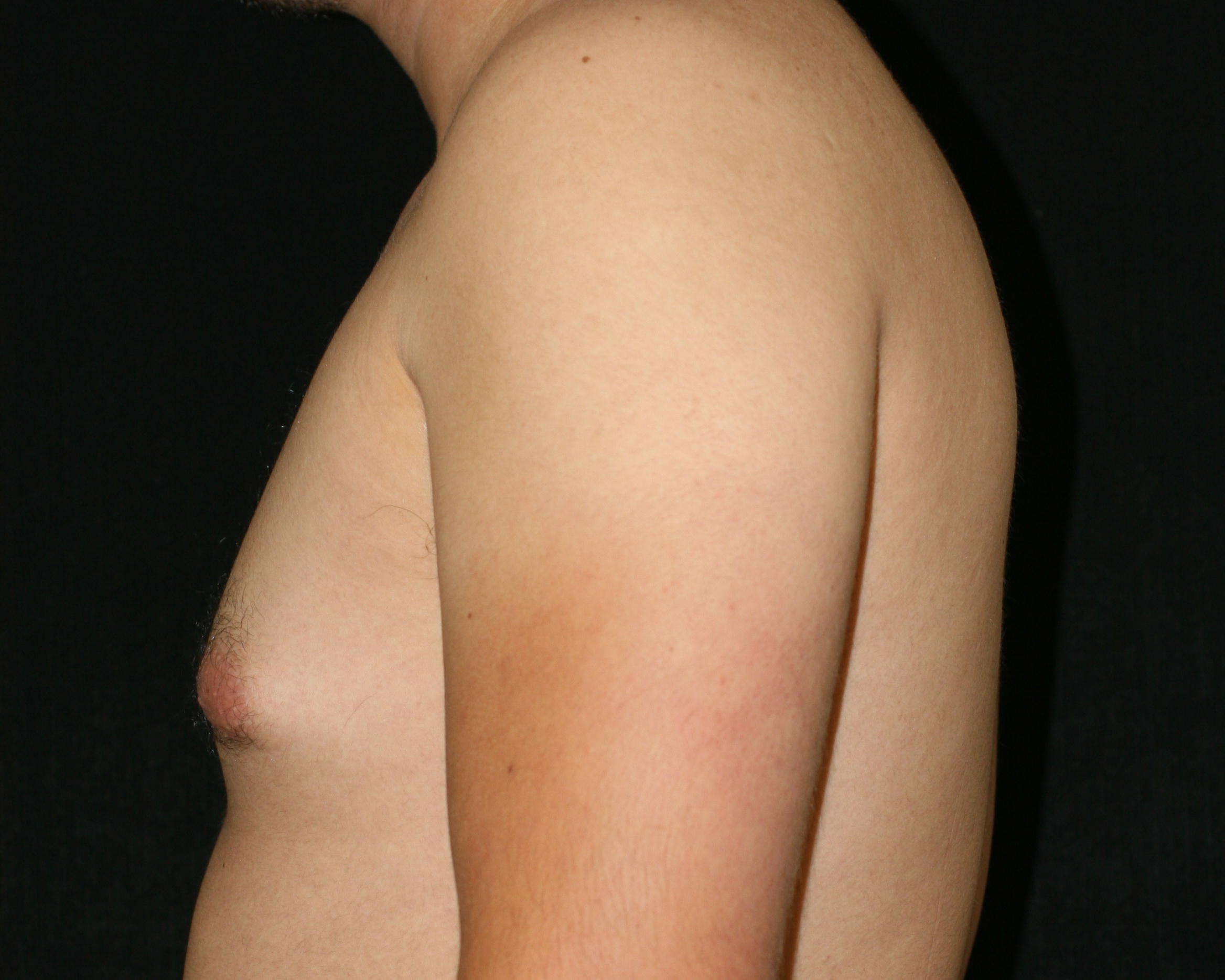 Gynecomastia with Liposuction to the Breasts