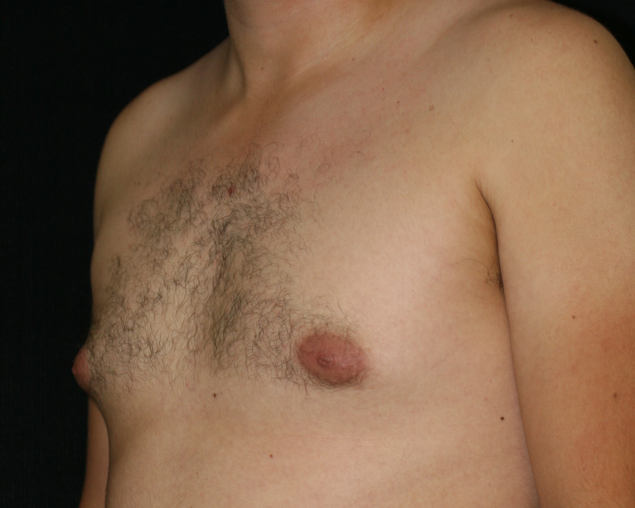 Male Breast Reduction - Before & After - Dr. Placik