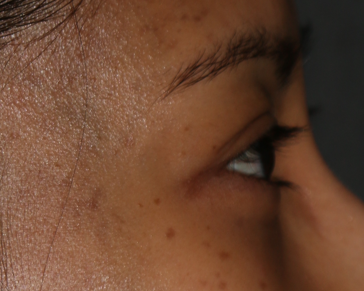 Injectable Filler - Before & After - Dr. Placik