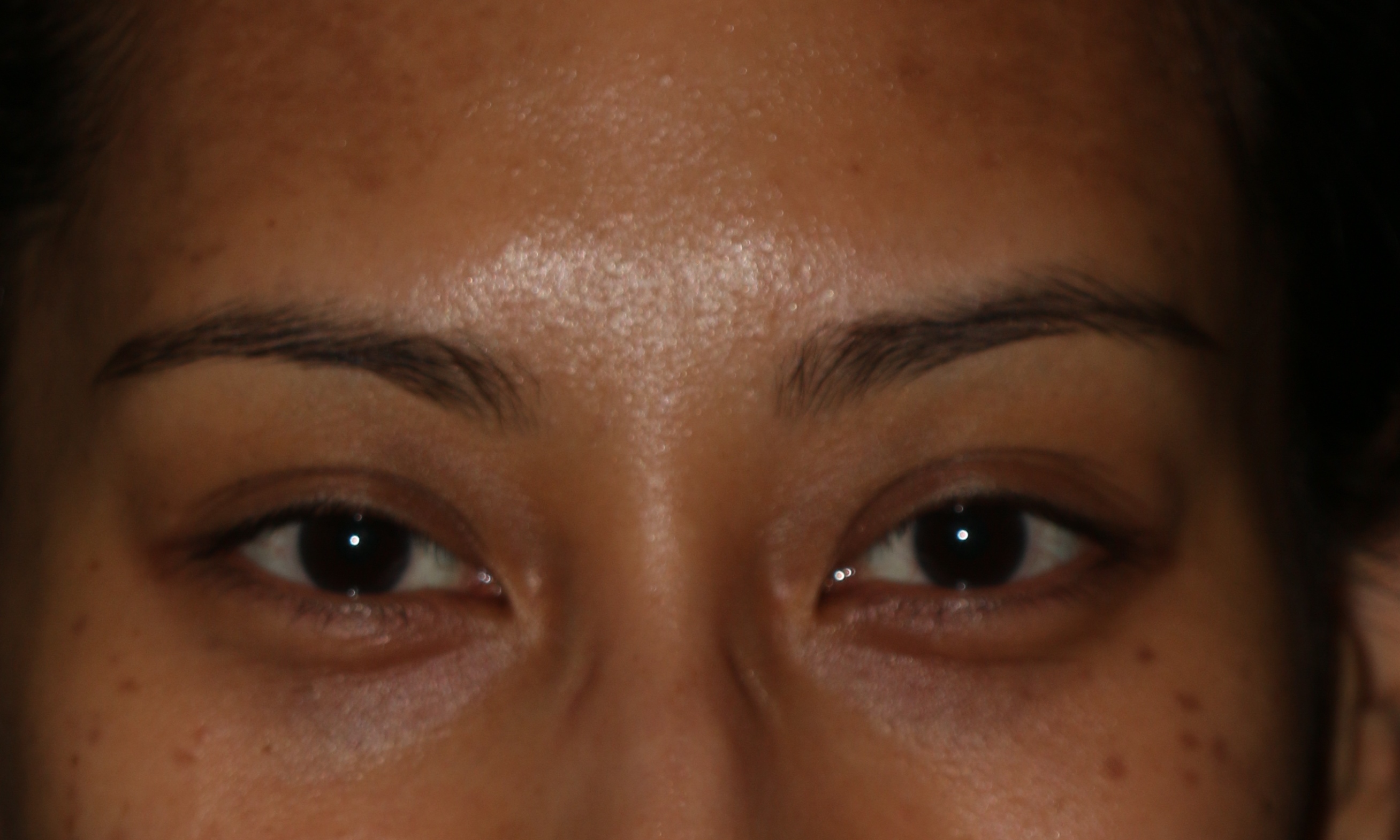 Injectable Filler Chicago