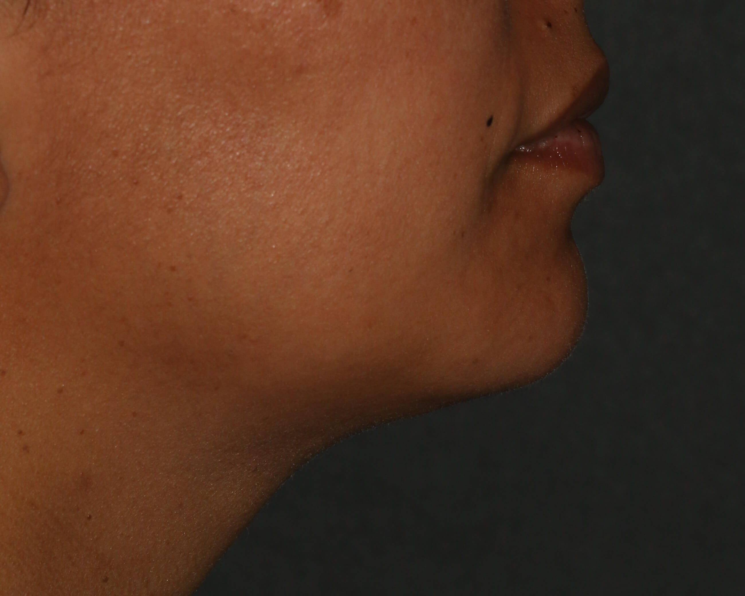 Kybella - Before & After - Dr. Placik