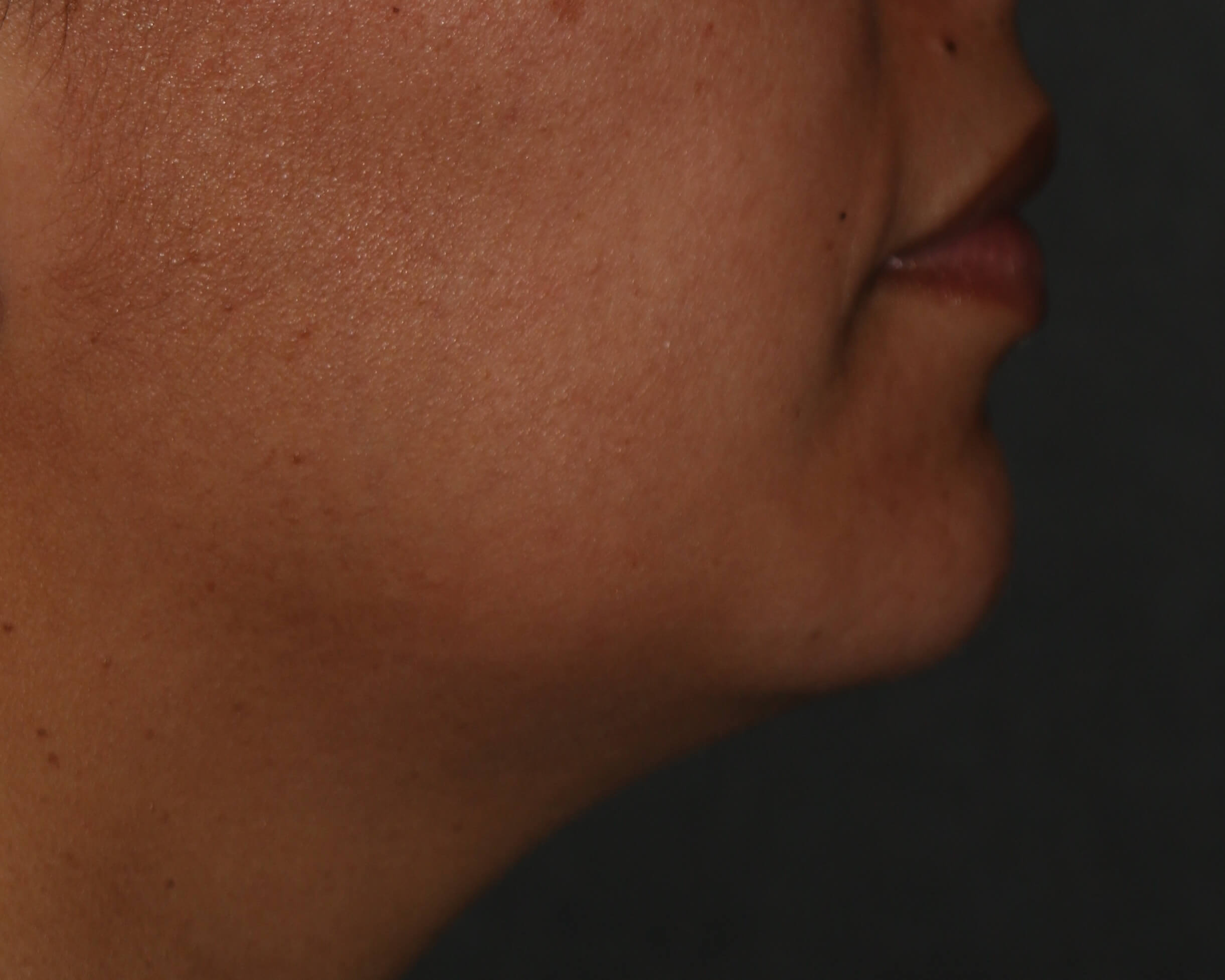 Kybella - Before & After - Dr. Placik