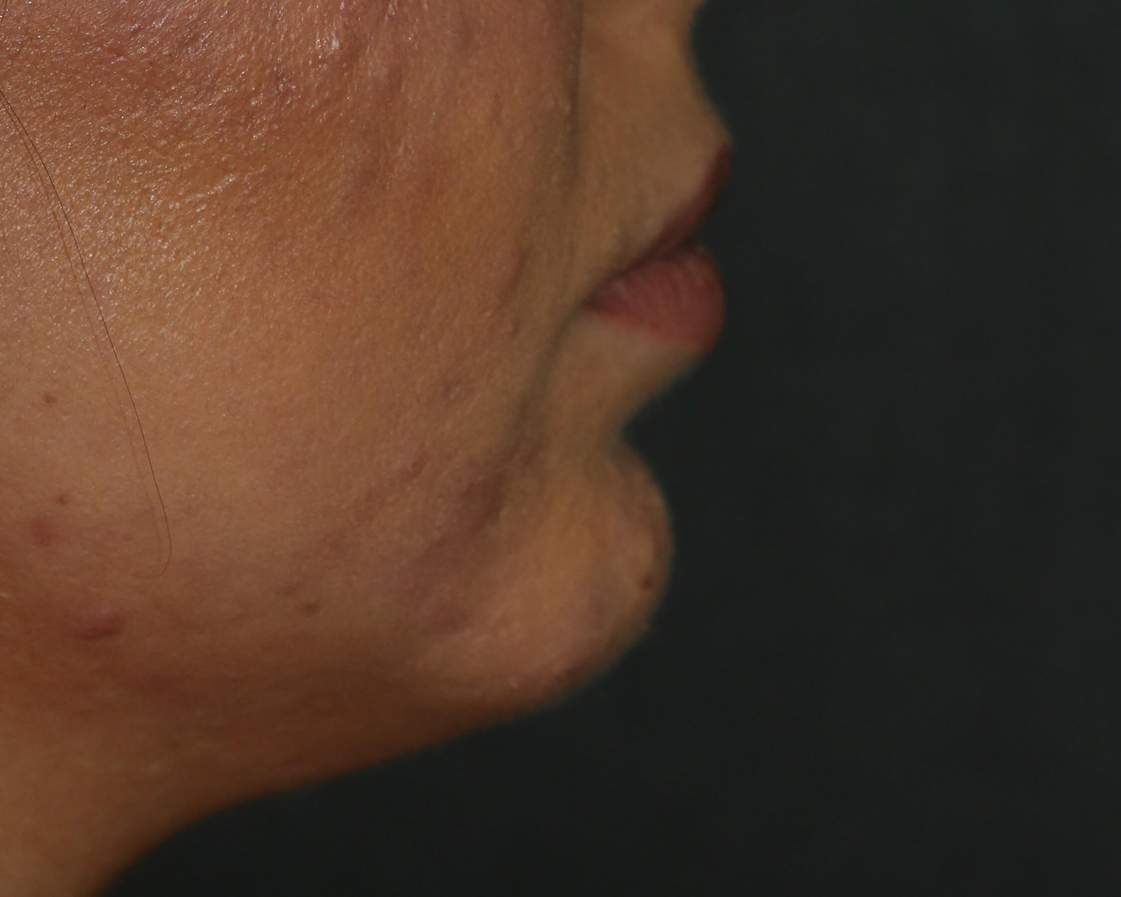 Chin Surgery - Before & After - Dr. Placik