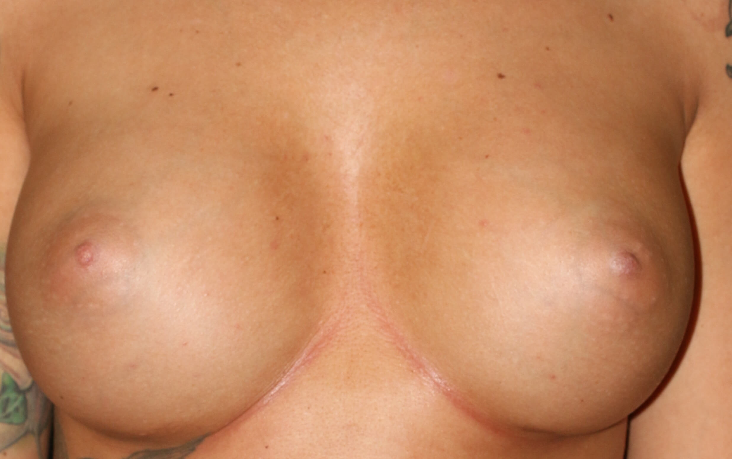 Before & After Breast Augmentation Gallery - Before & After - Dr. Placik