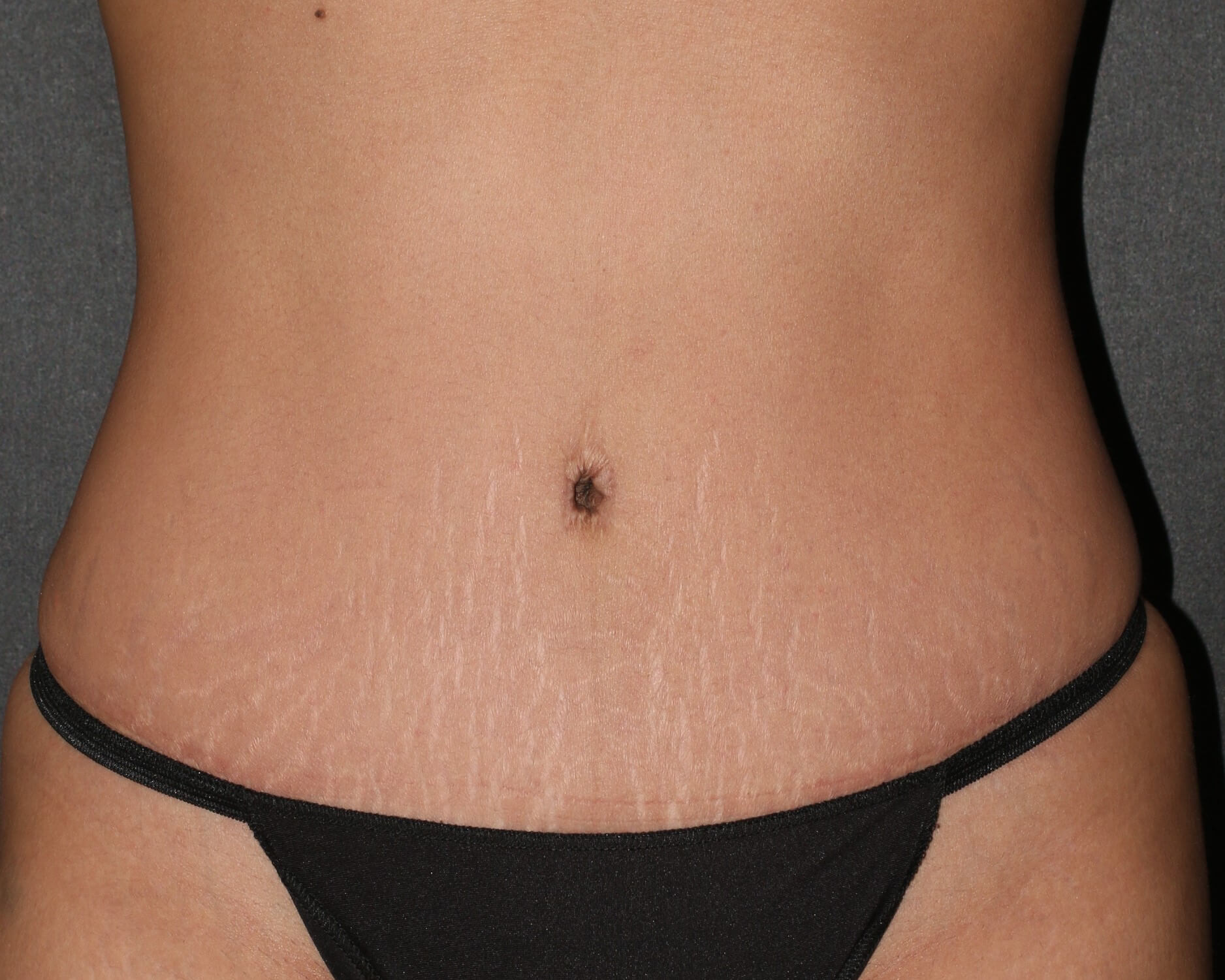 Tummy Tuck - Before & After - Dr. Placik