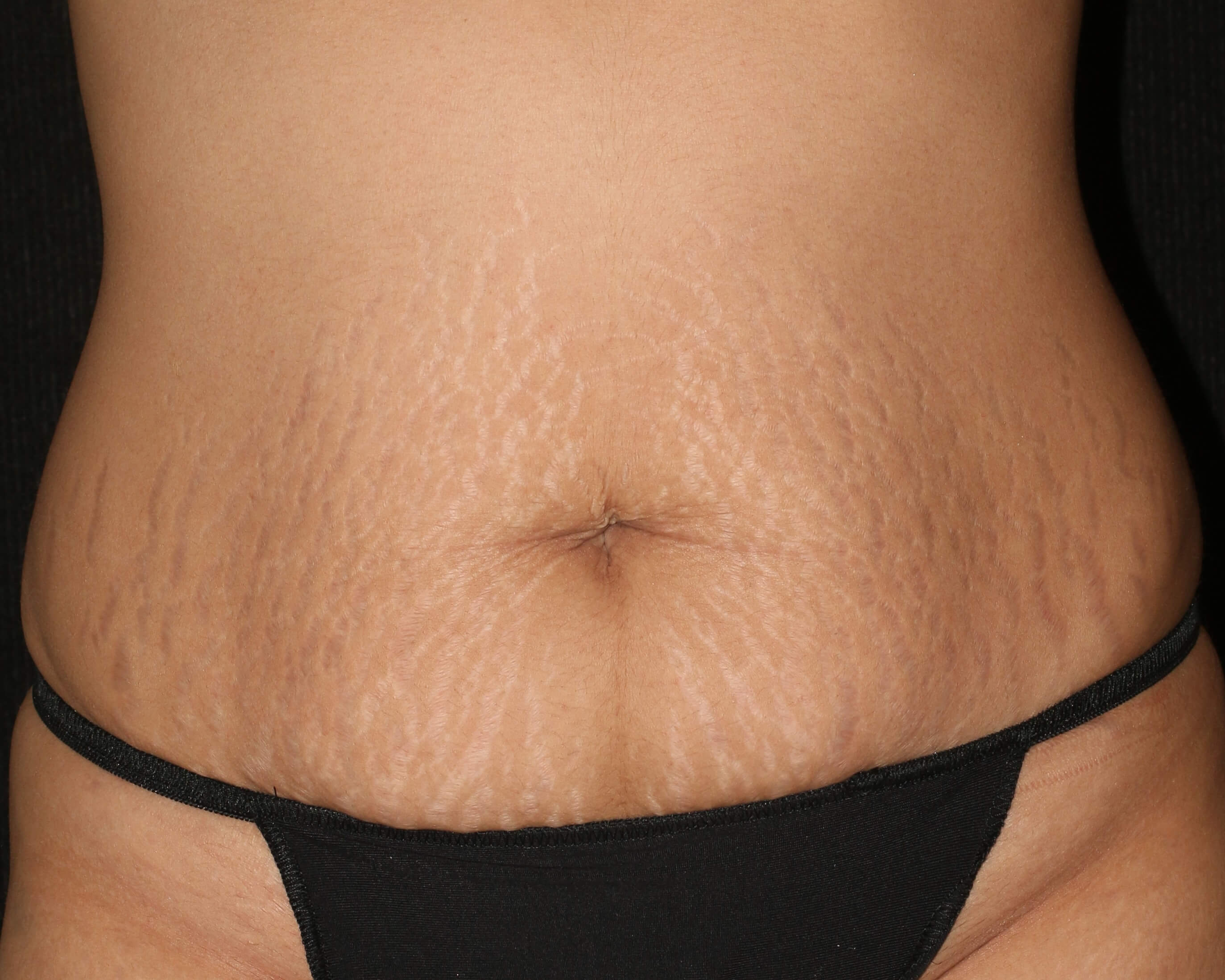 Tummy Tuck - Before & After - Dr. Placik