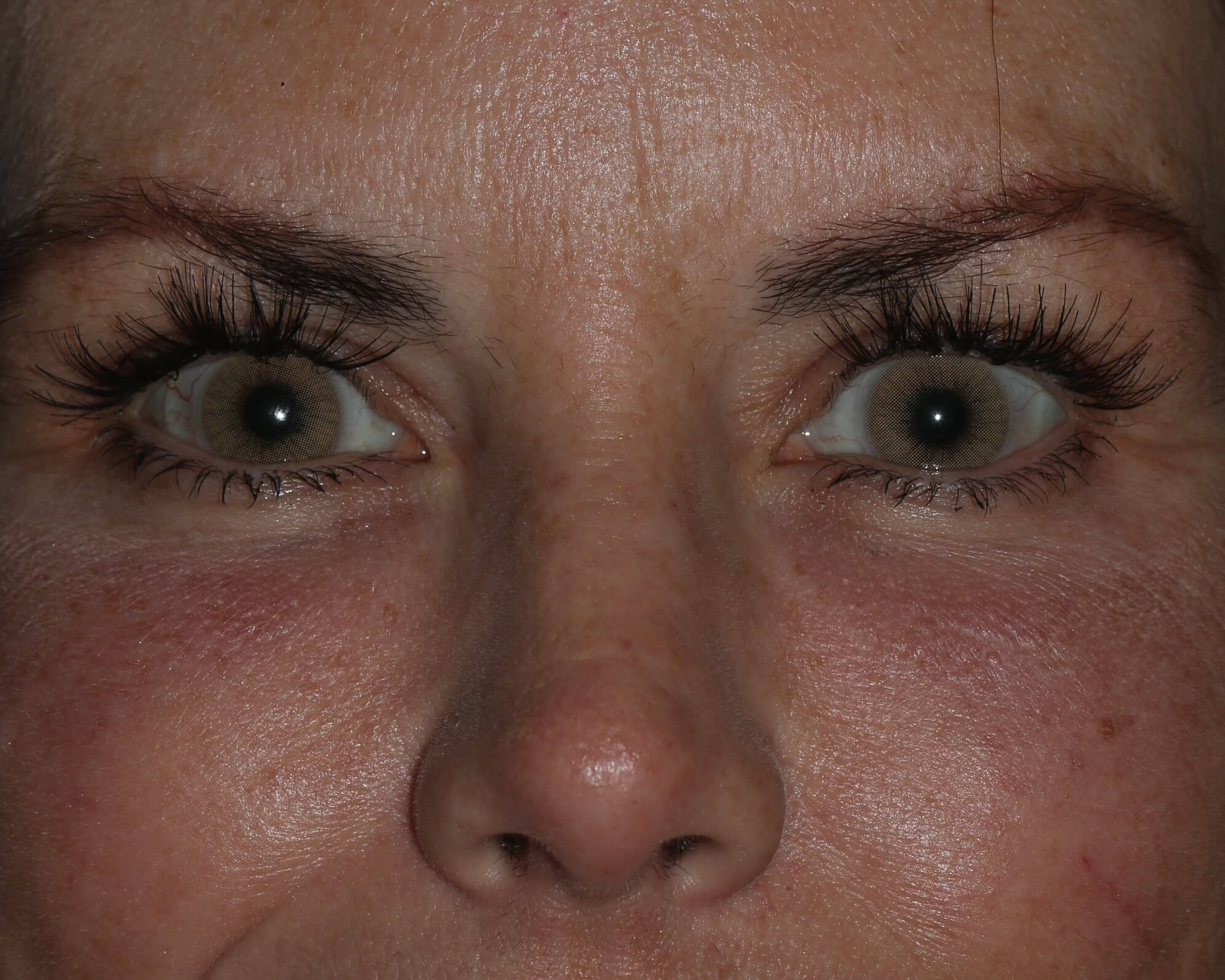 Injectable Filler - Before & After - Dr. Placik