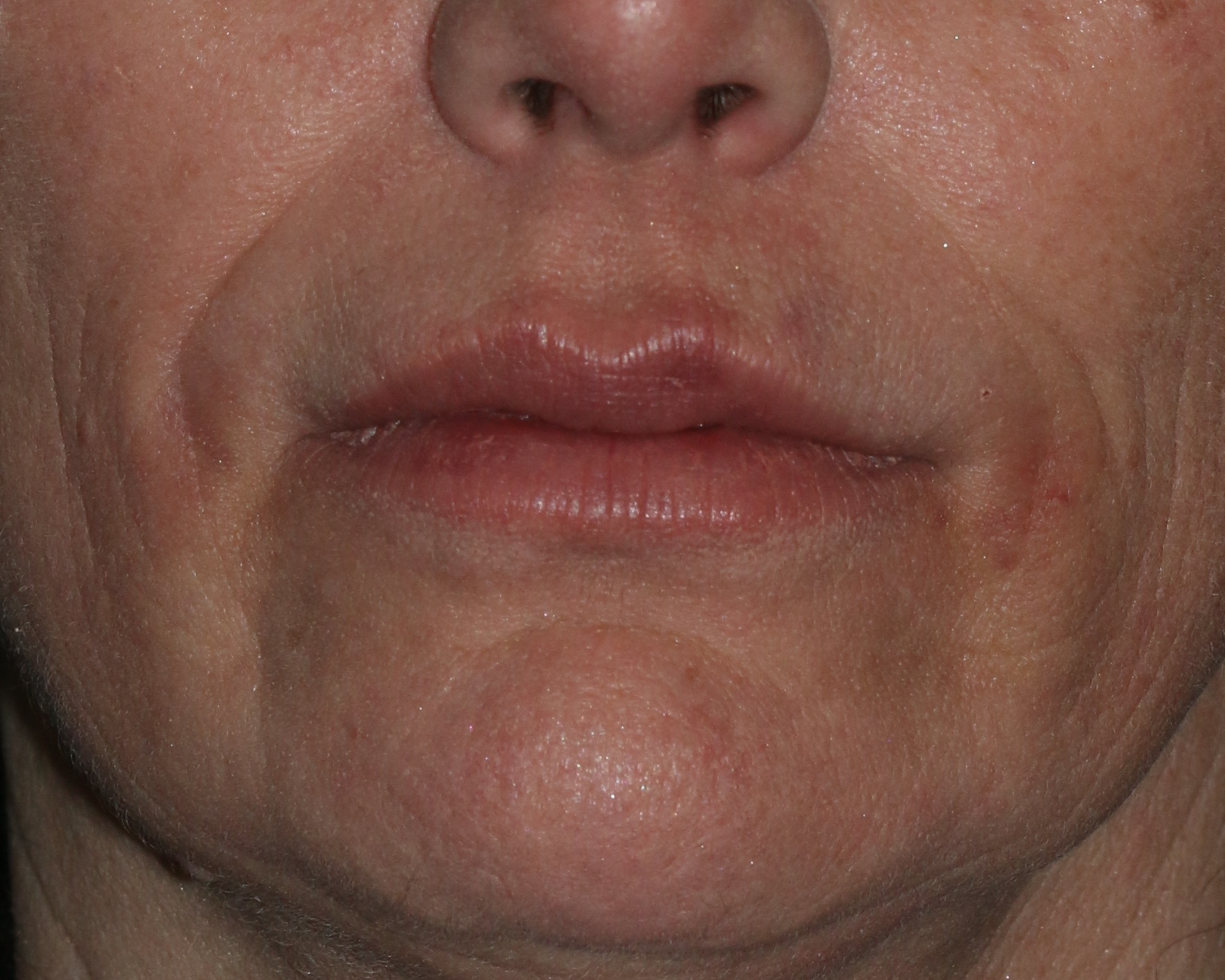 Lip Enhancement - Before & After - Dr. Placik