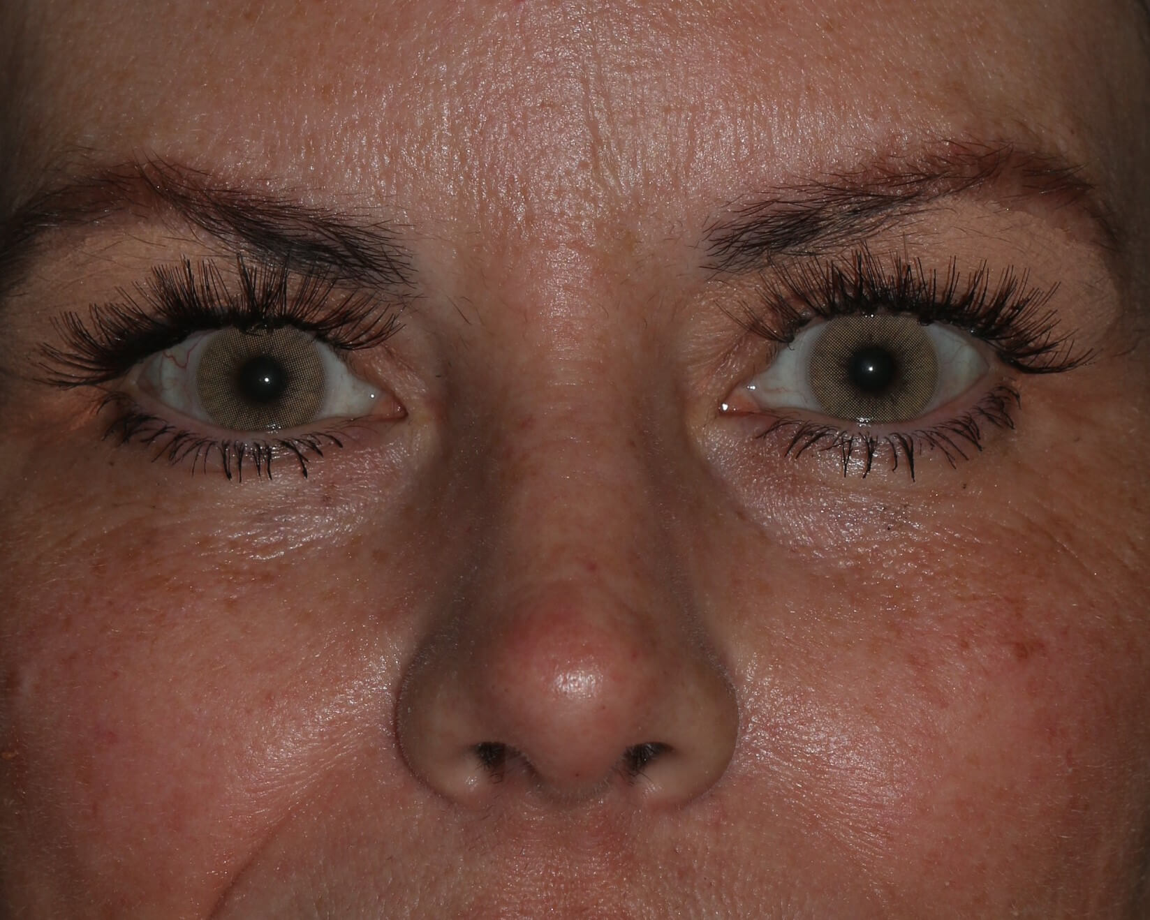 Injectable Filler - Before & After - Dr. Placik