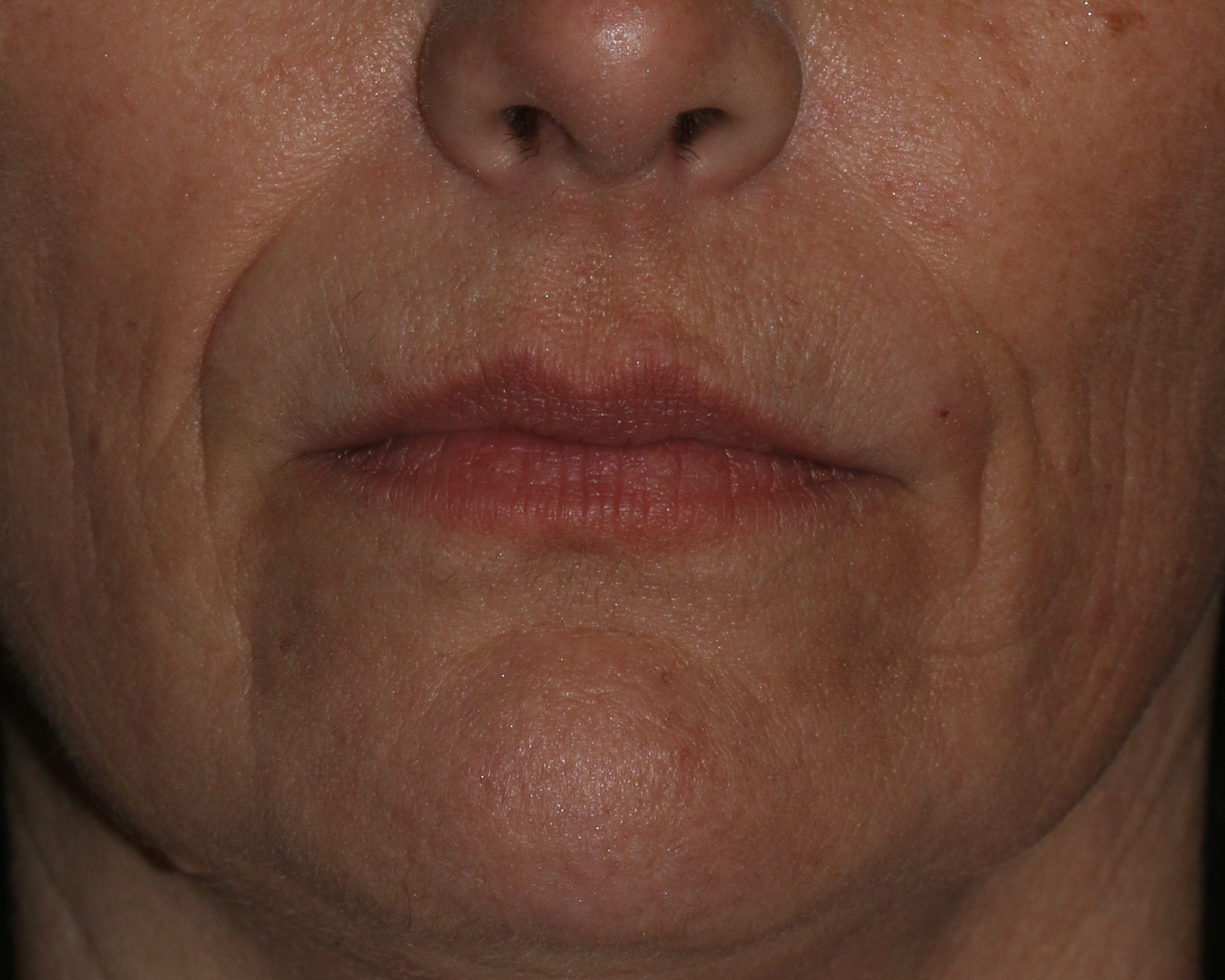 Lip Enhancement - Before & After - Dr. Placik