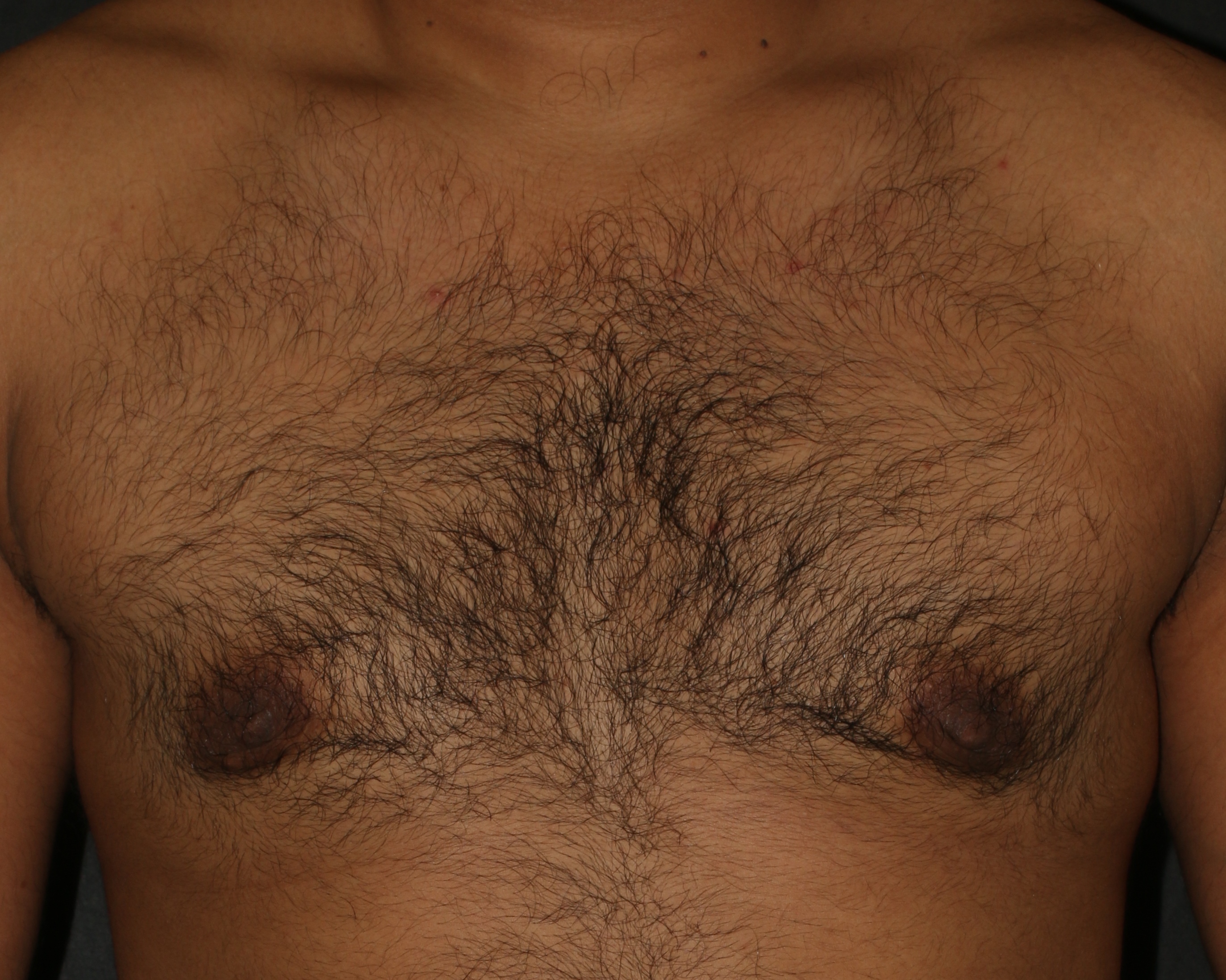 Gynecomastia utilizing excision & liposuction