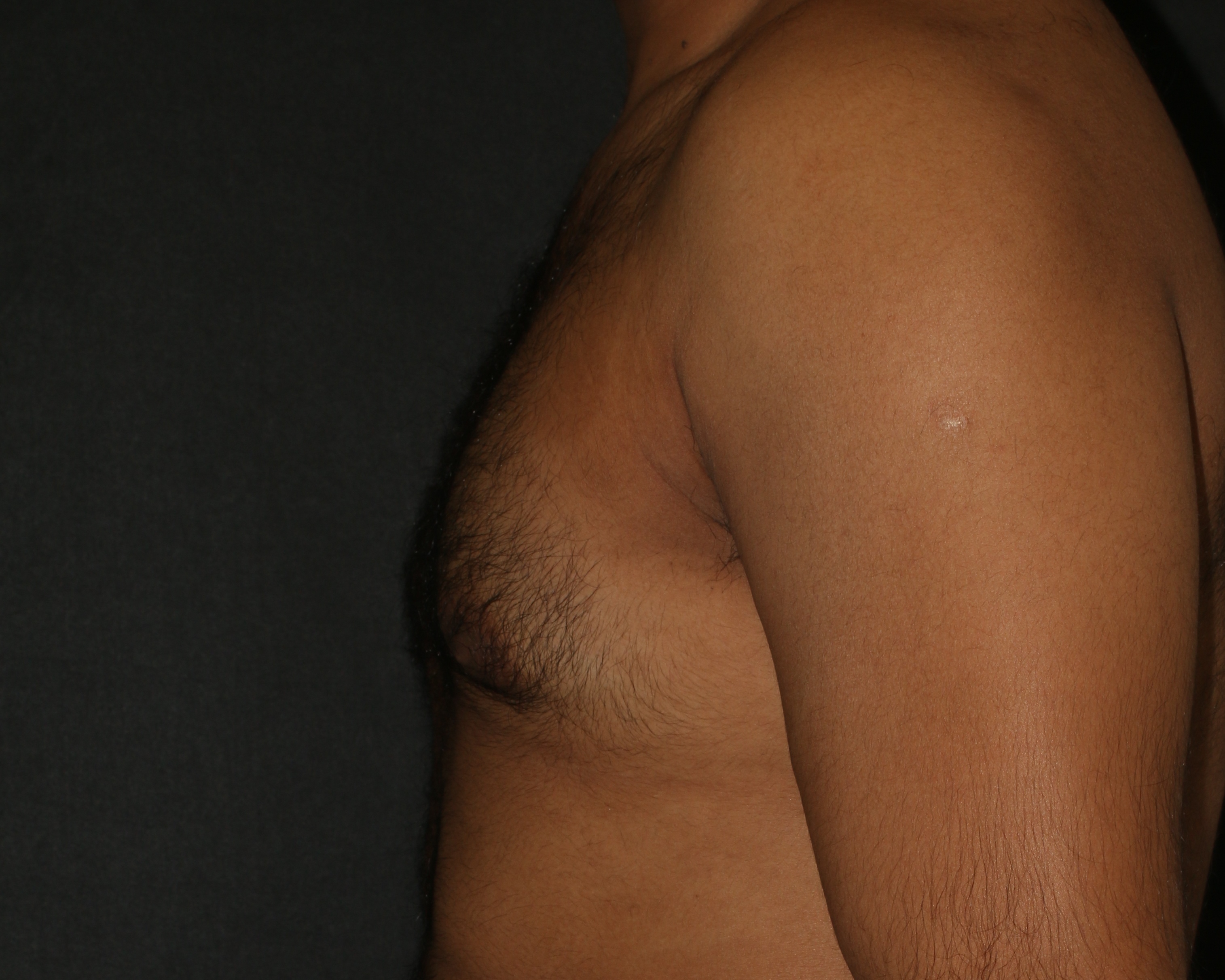 Male Breast Reduction - Before & After - Dr. Placik