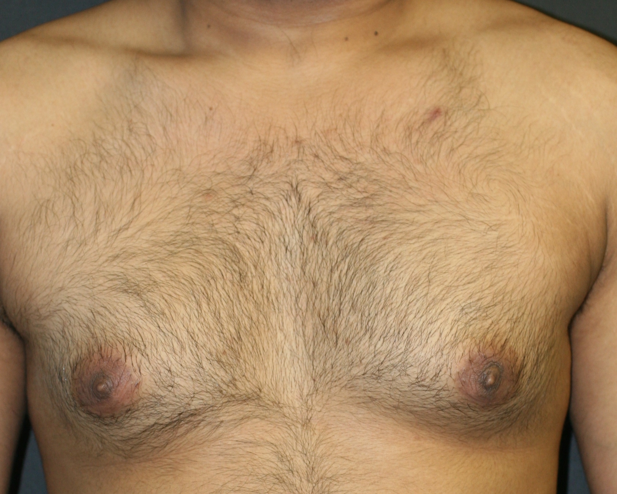 Gynecomastia utilizing excision & liposuction