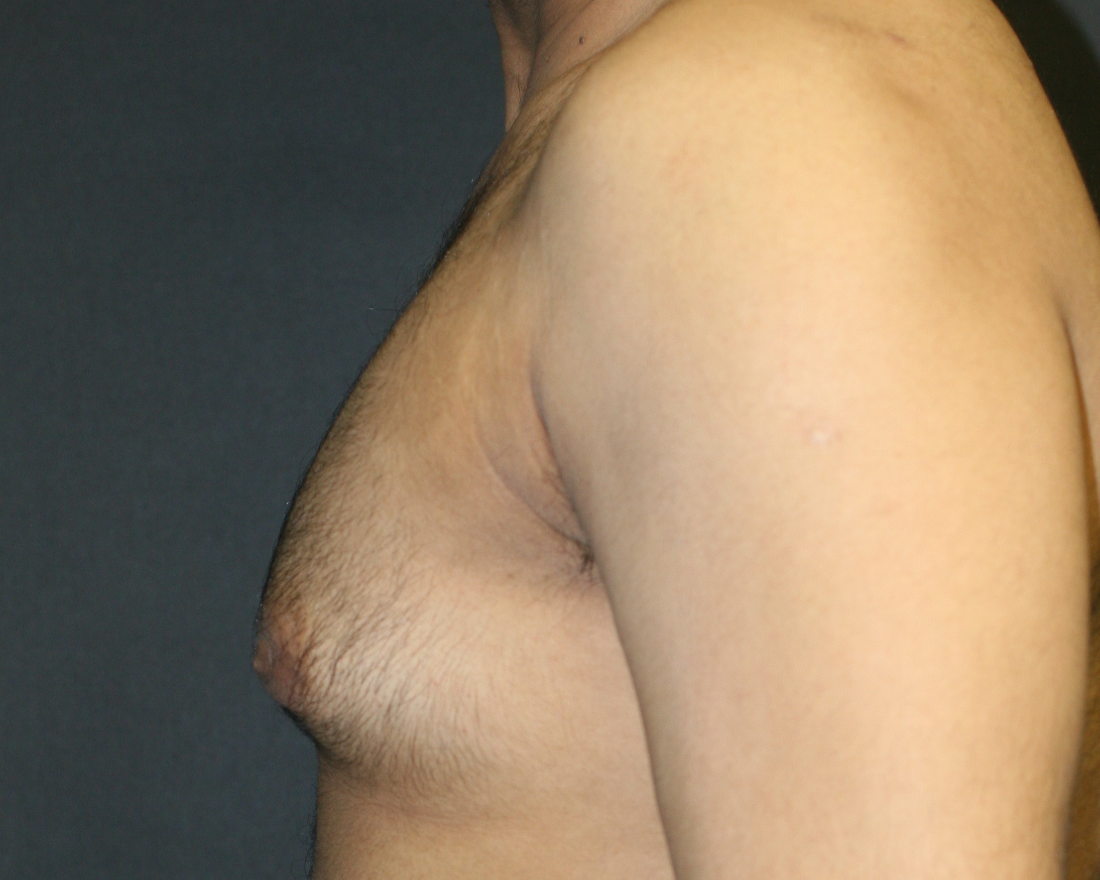 Male Breast Reduction - Before & After - Dr. Placik