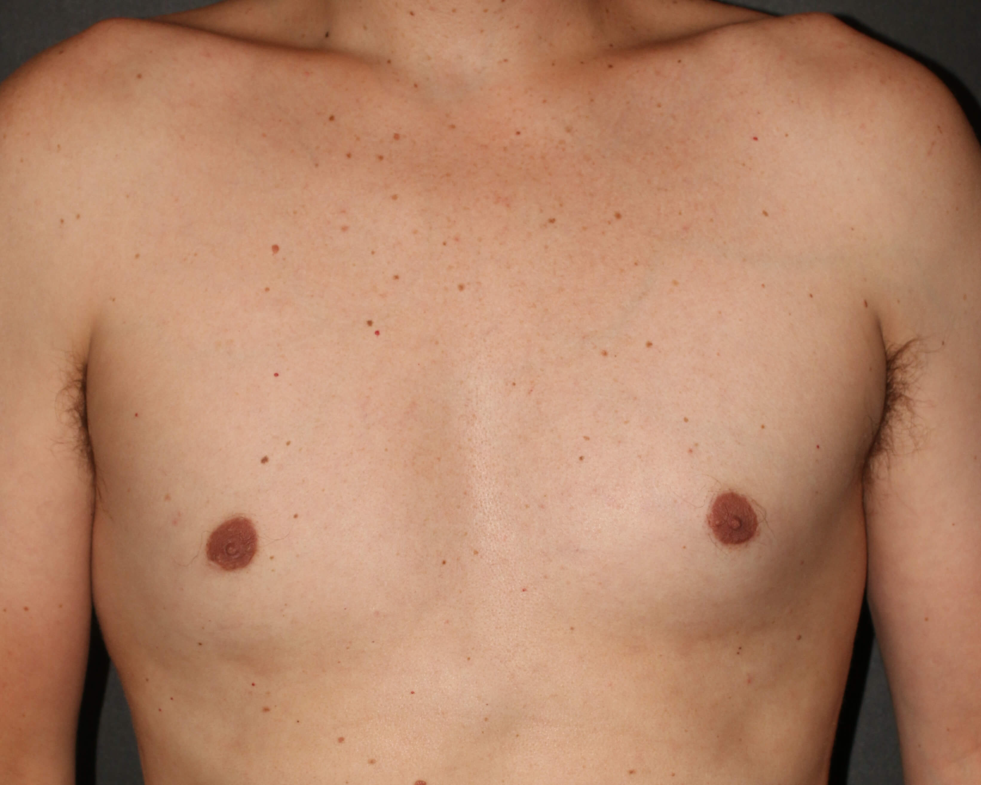 Male Breast Reduction - Before & After - Dr. Placik