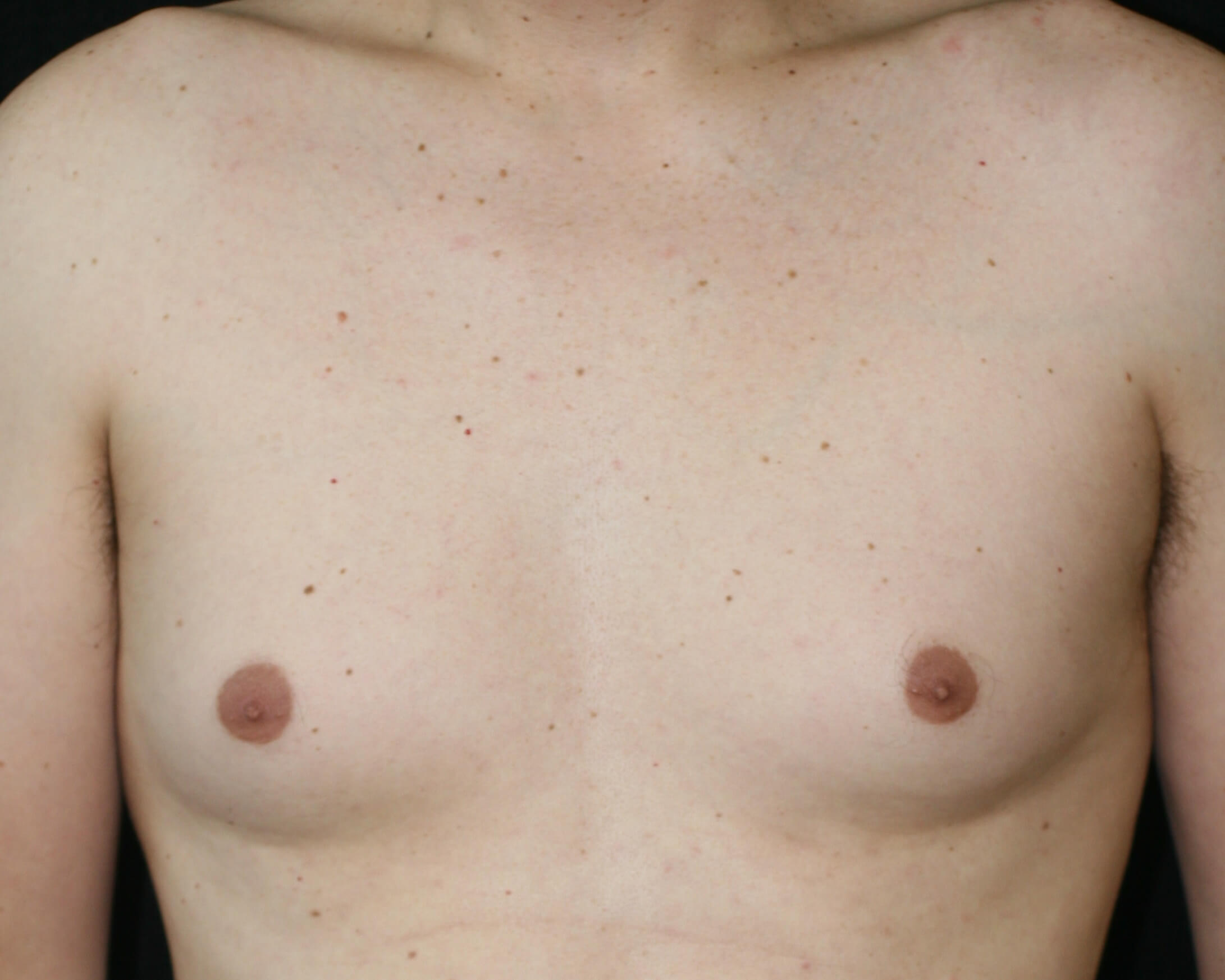 Male Breast Reduction - Before & After - Dr. Placik