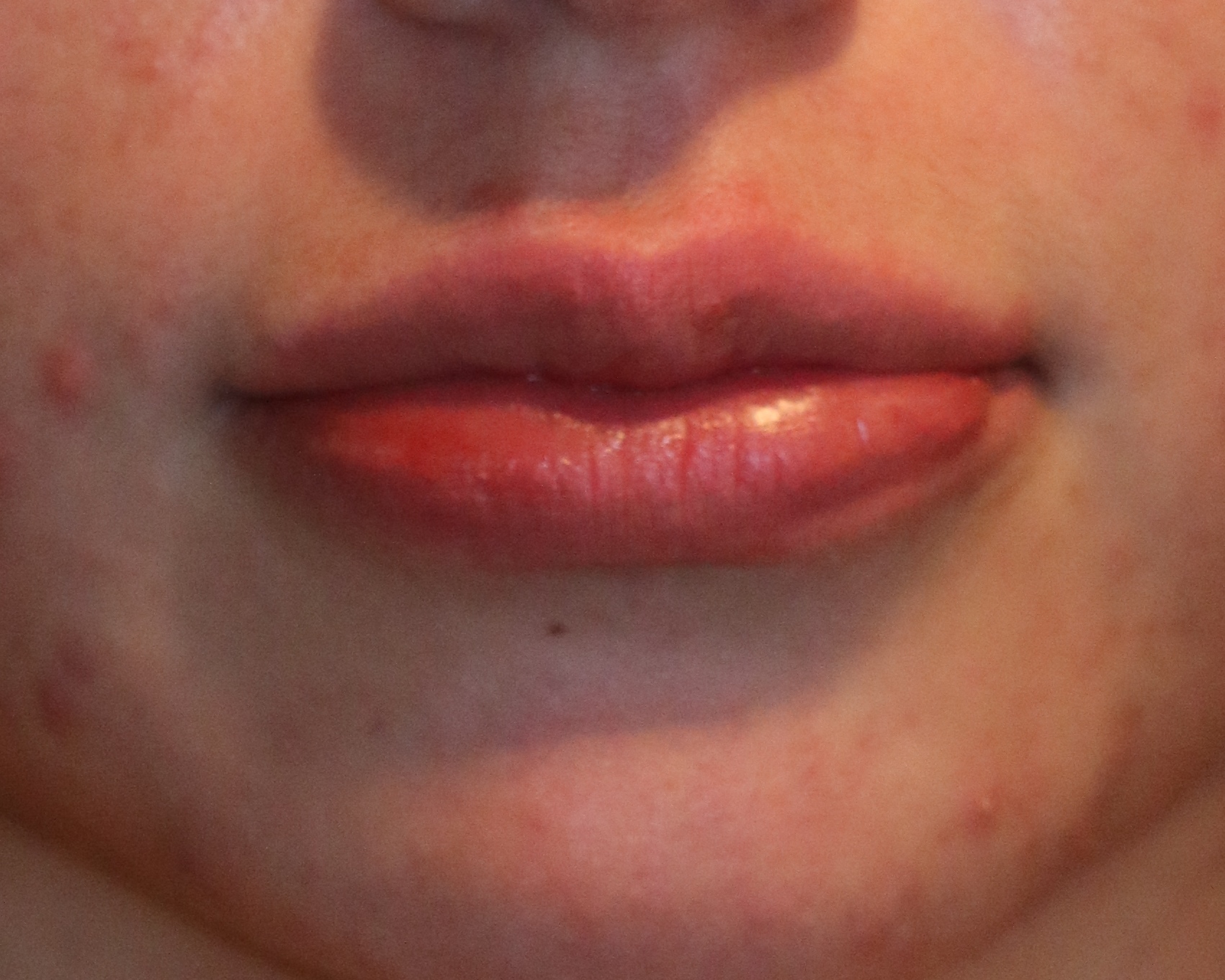 Lip Enhancement - Before & After - Dr. Placik