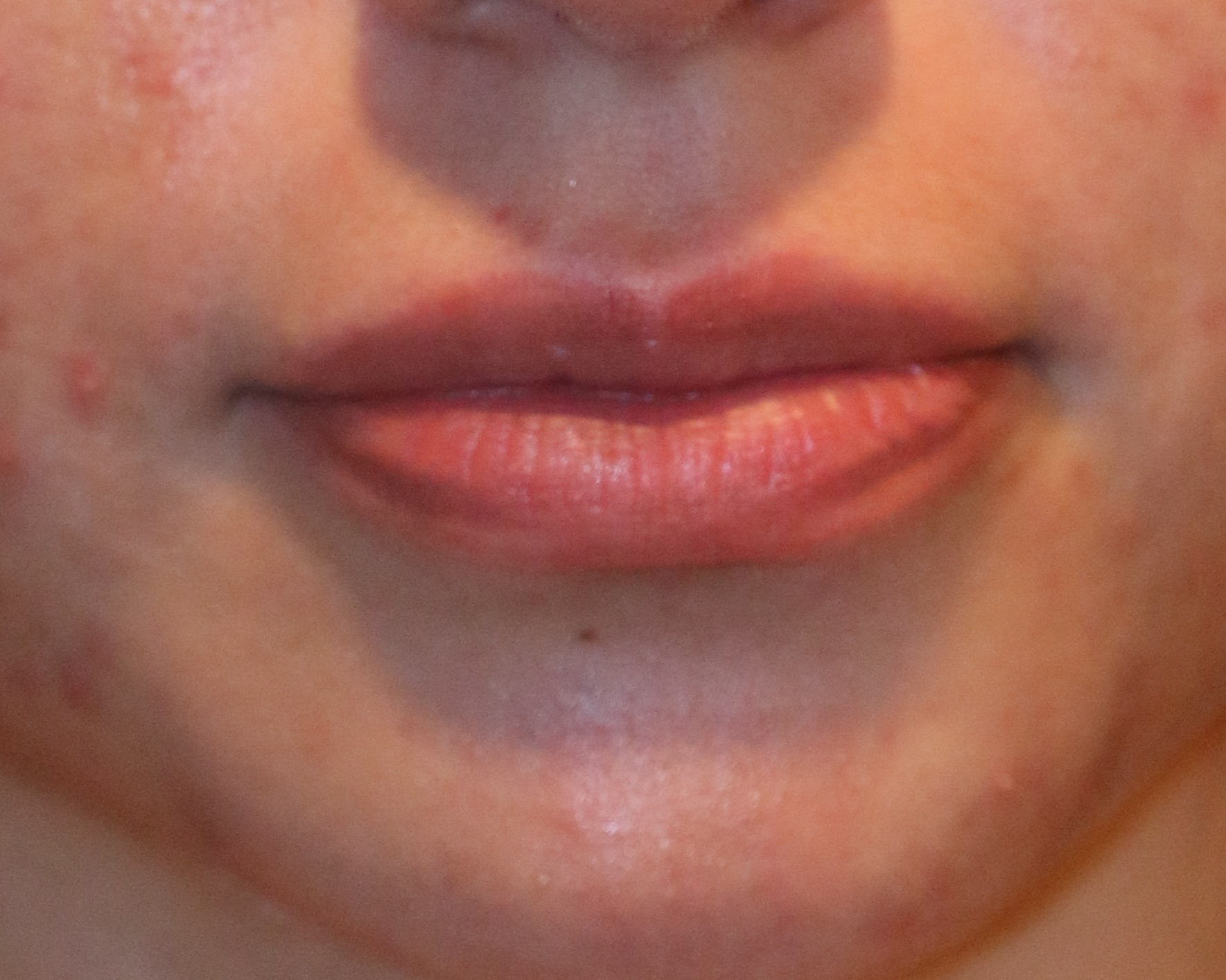 Lip Enhancement - Before & After - Dr. Placik