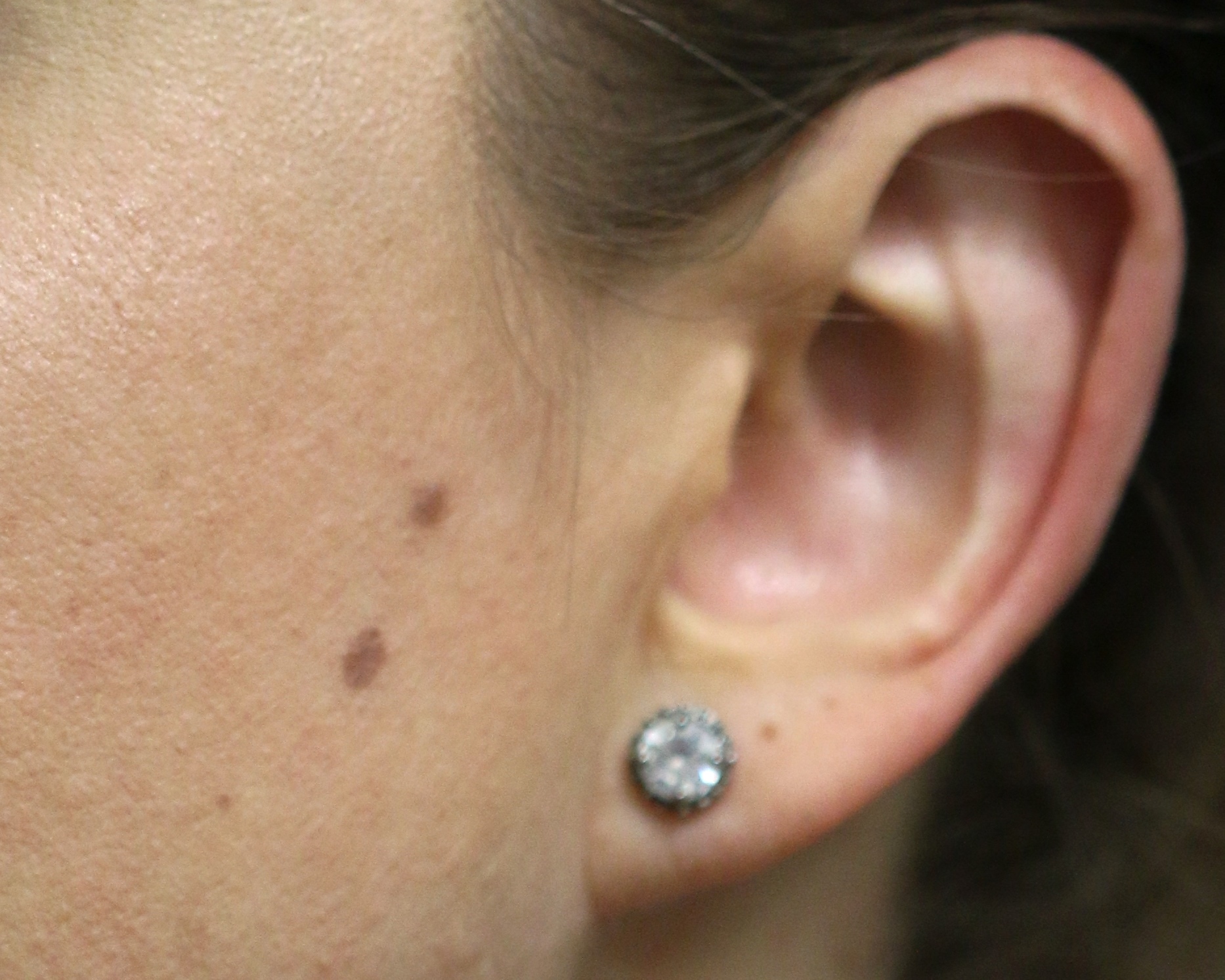 Earlobe Repair - Before & After - Dr. Placik