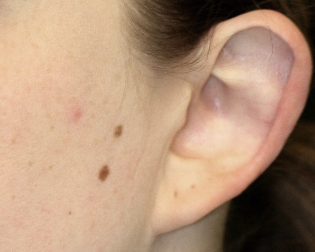 Earlobe Repair - Before & After - Dr. Placik