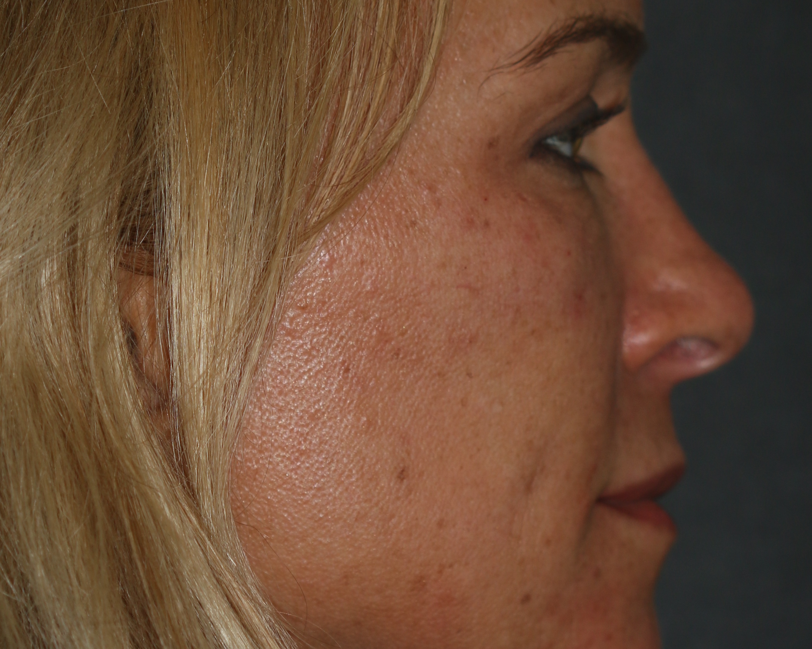 Injectable Filler - Before & After - Dr. Placik