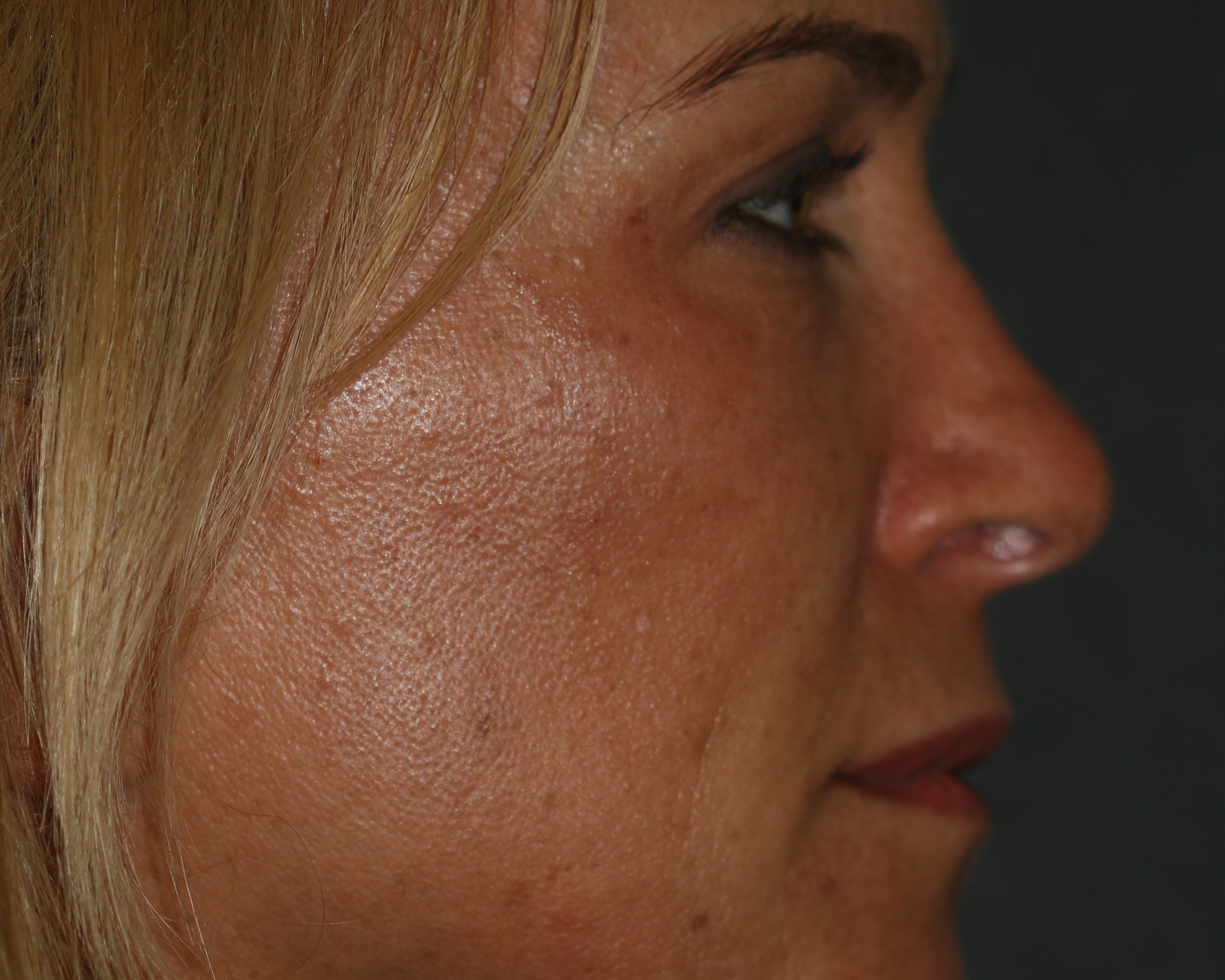 Injectable Filler - Before & After - Dr. Placik