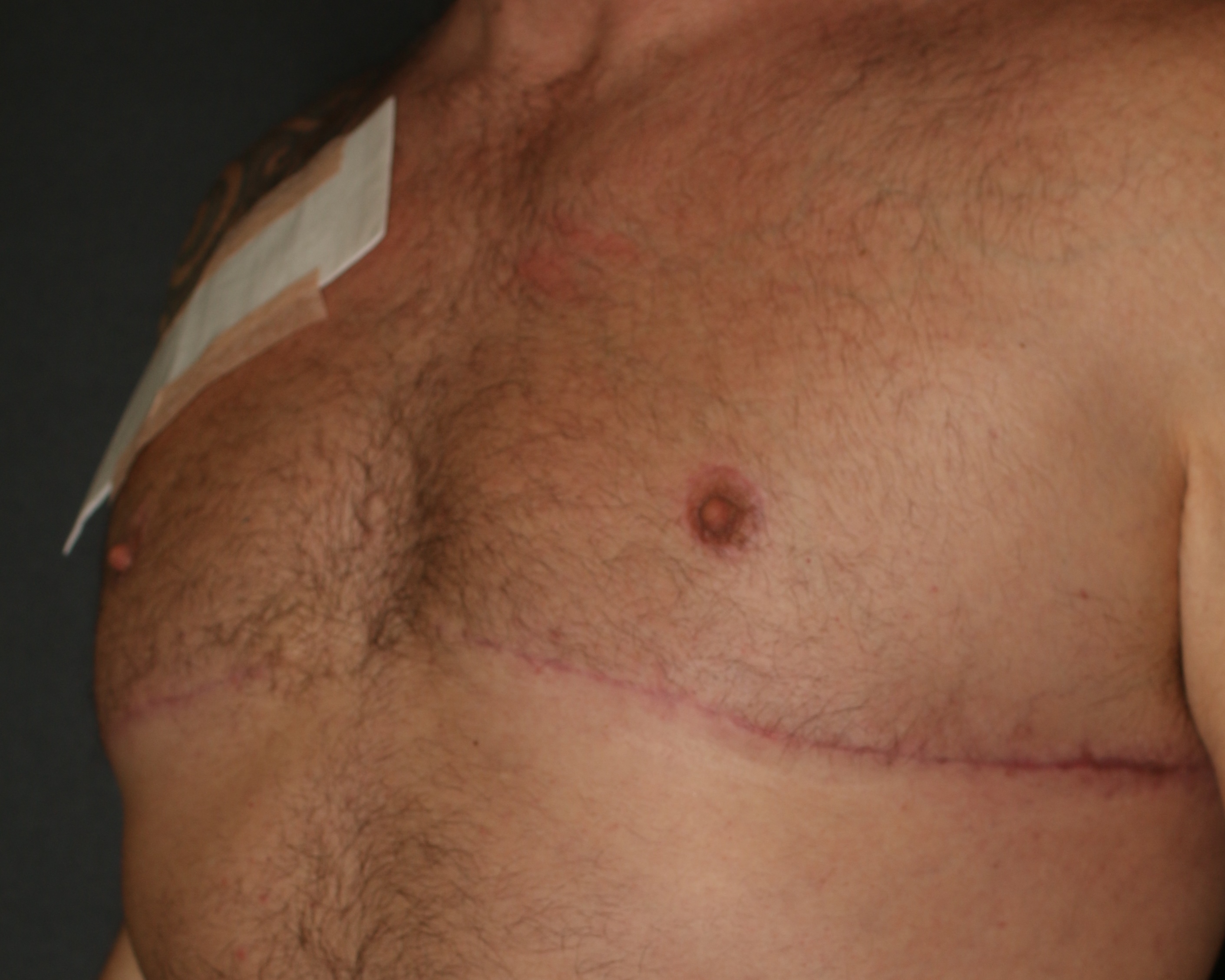 Male Breast Reduction - Before & After - Dr. Placik