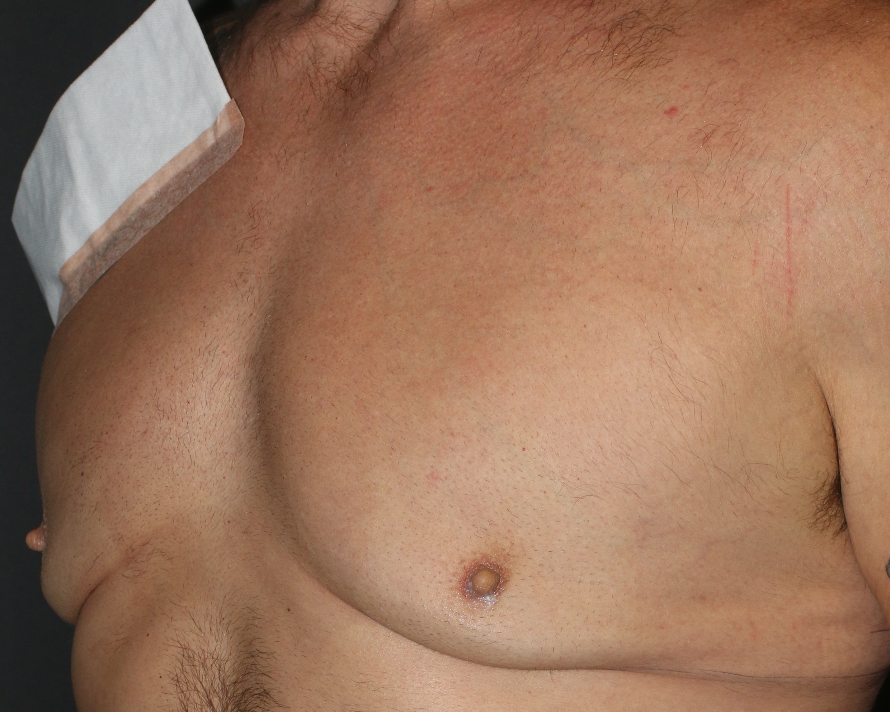 Male Breast Reduction - Before & After - Dr. Placik